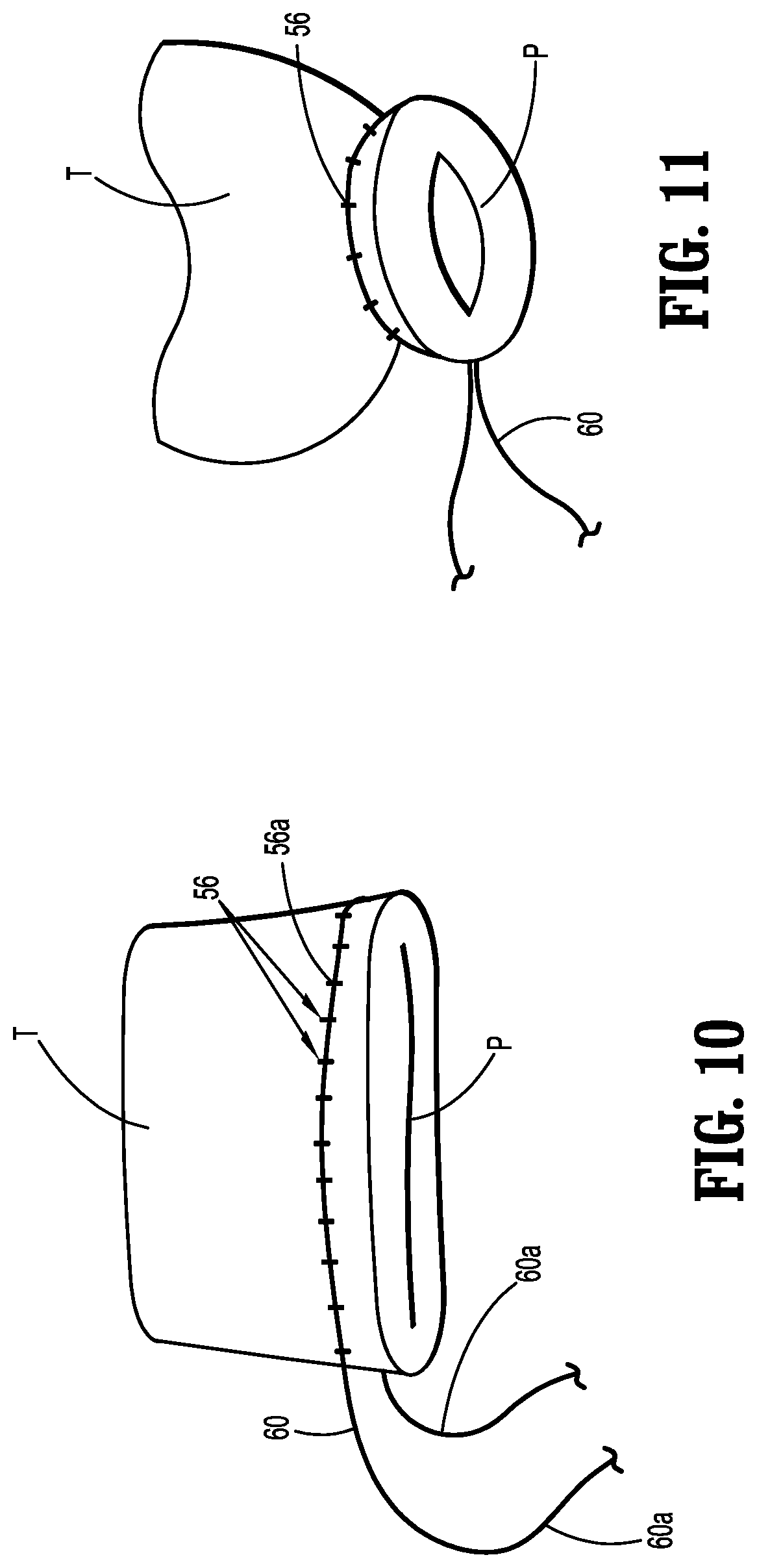 Patent US11779342 Figure 6 – Laparoscopic purse string suture device