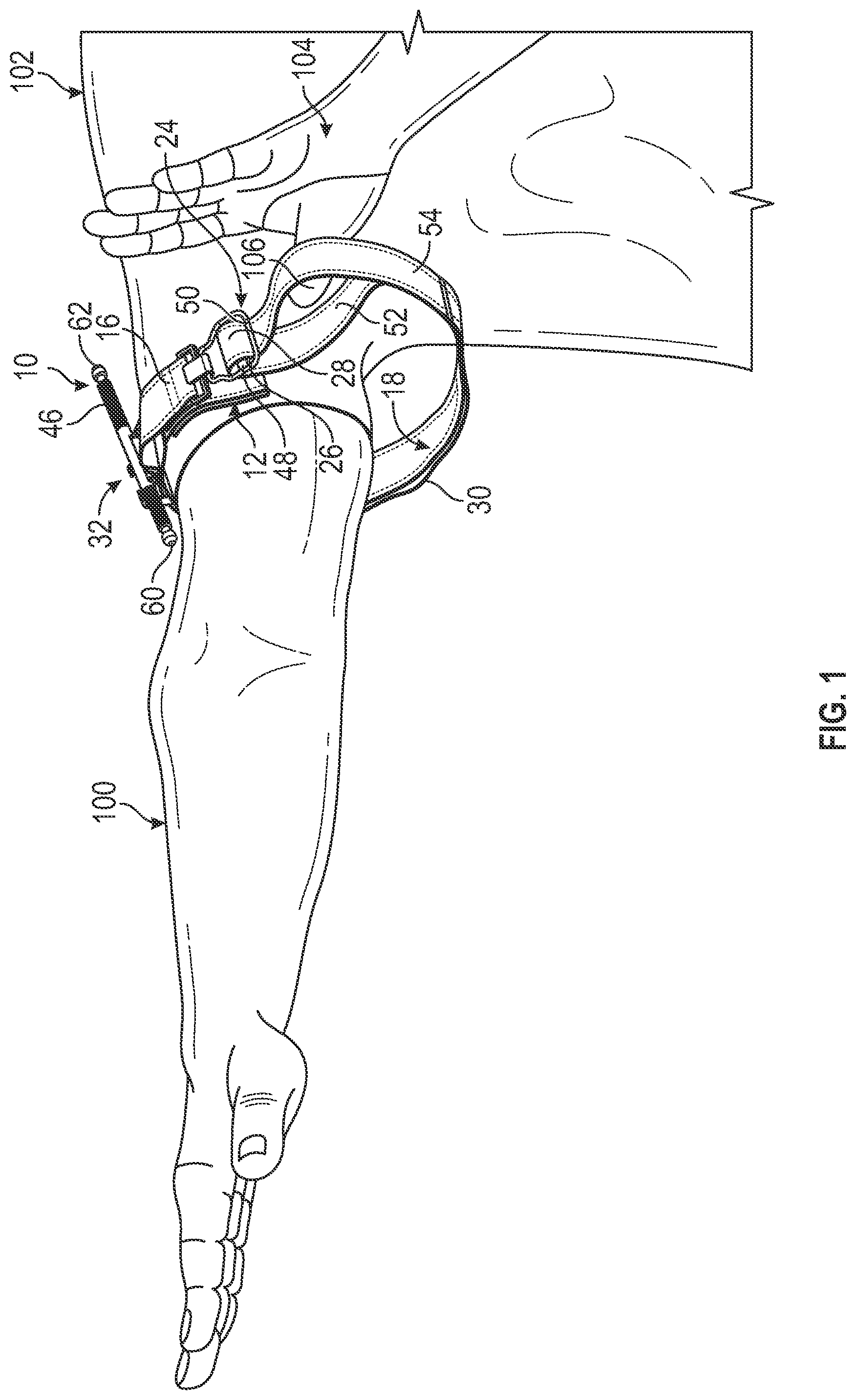 Patent US11779345 Figure 1 – Tourniquet