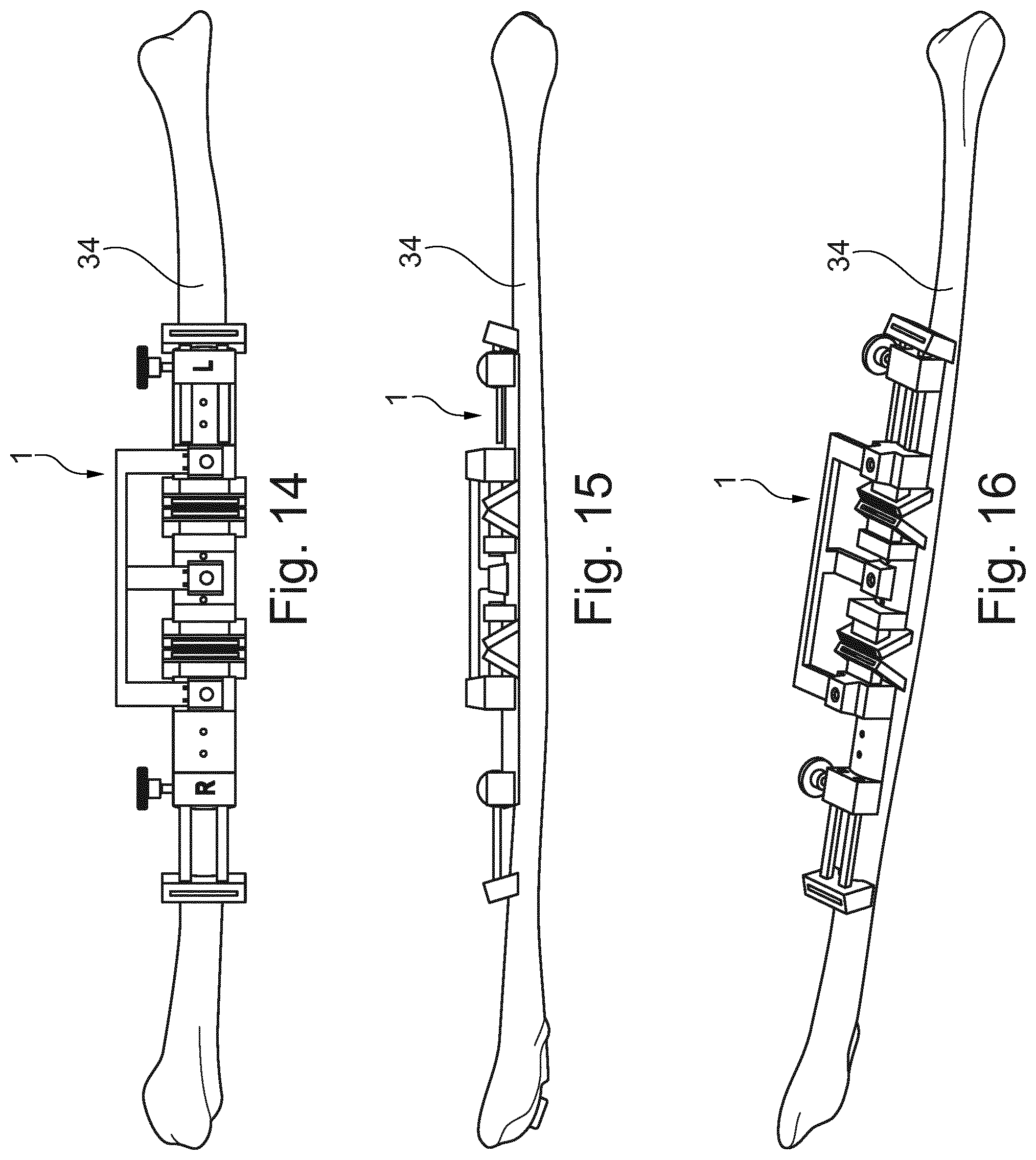 Patent US11779346 Figure 8 – Fibula bone material removal and transfer template