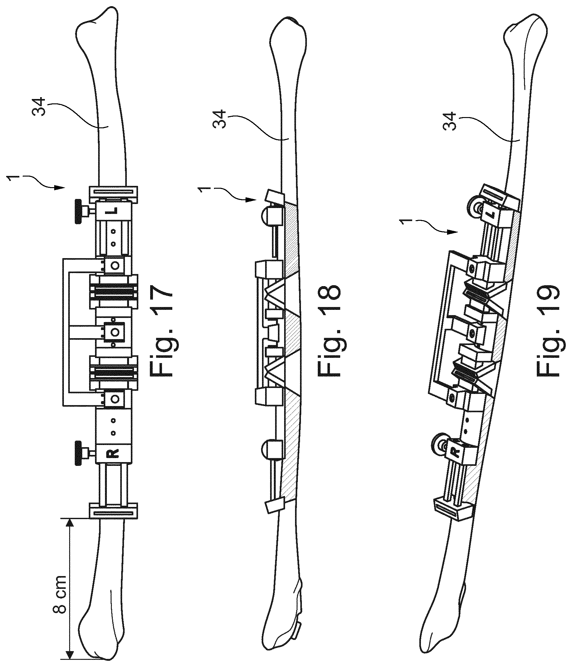 Patent US11779346 Figure 9 – Fibula bone material removal and transfer template