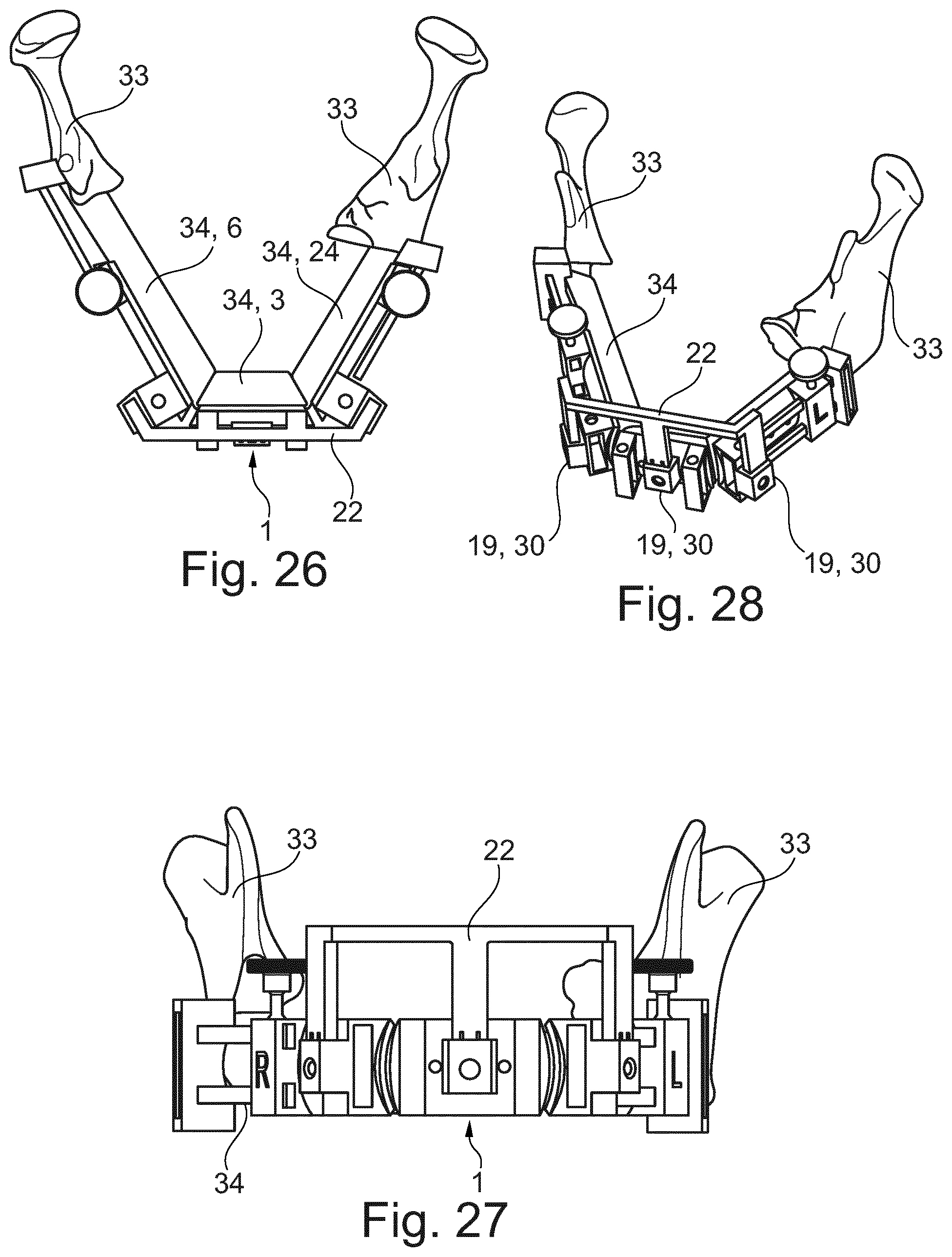 Patent US11779346 Figure 12 – Fibula bone material removal and transfer template