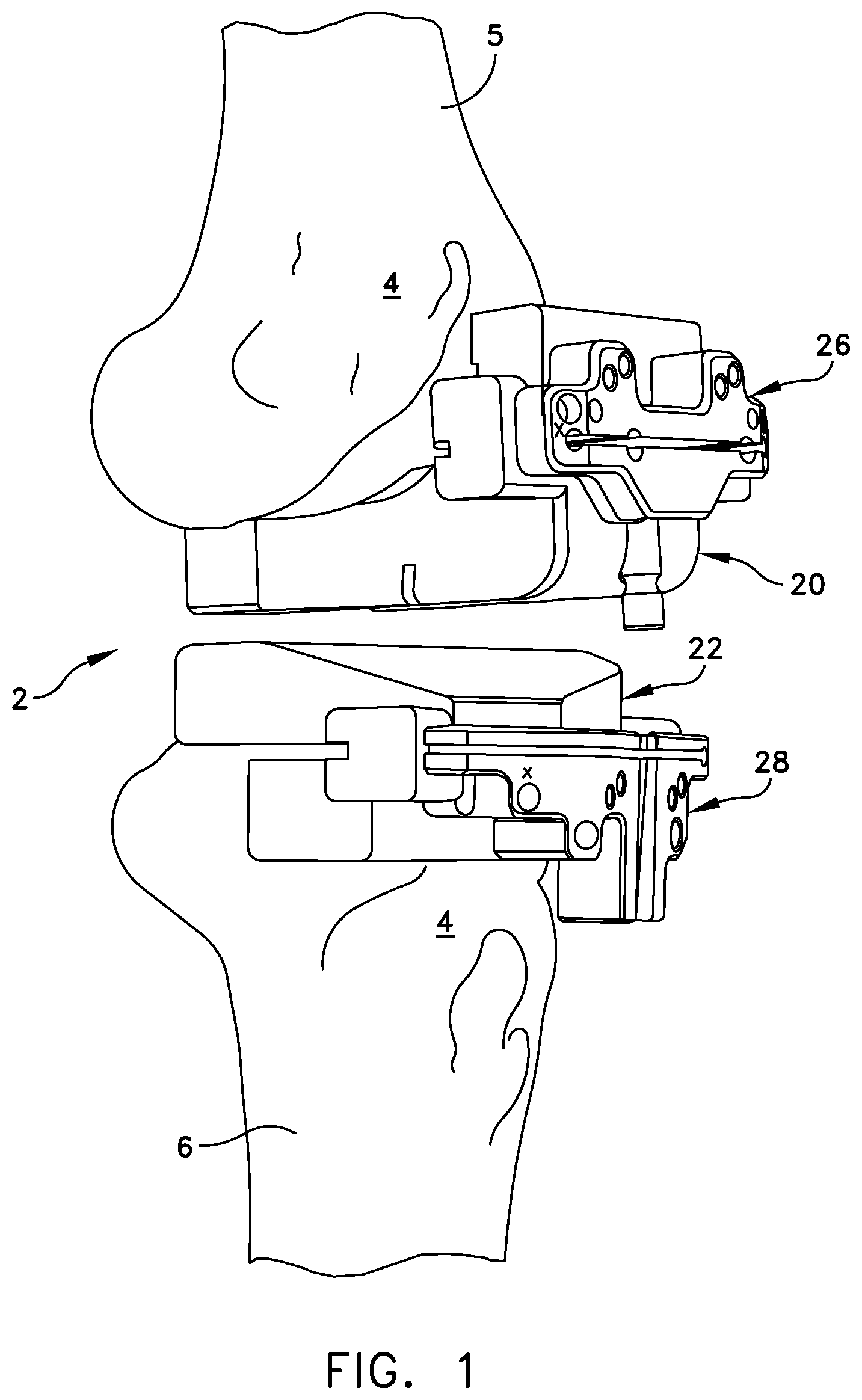 Patent US11779347 Figure 1 – System for forming a patient specific surgical guide mount