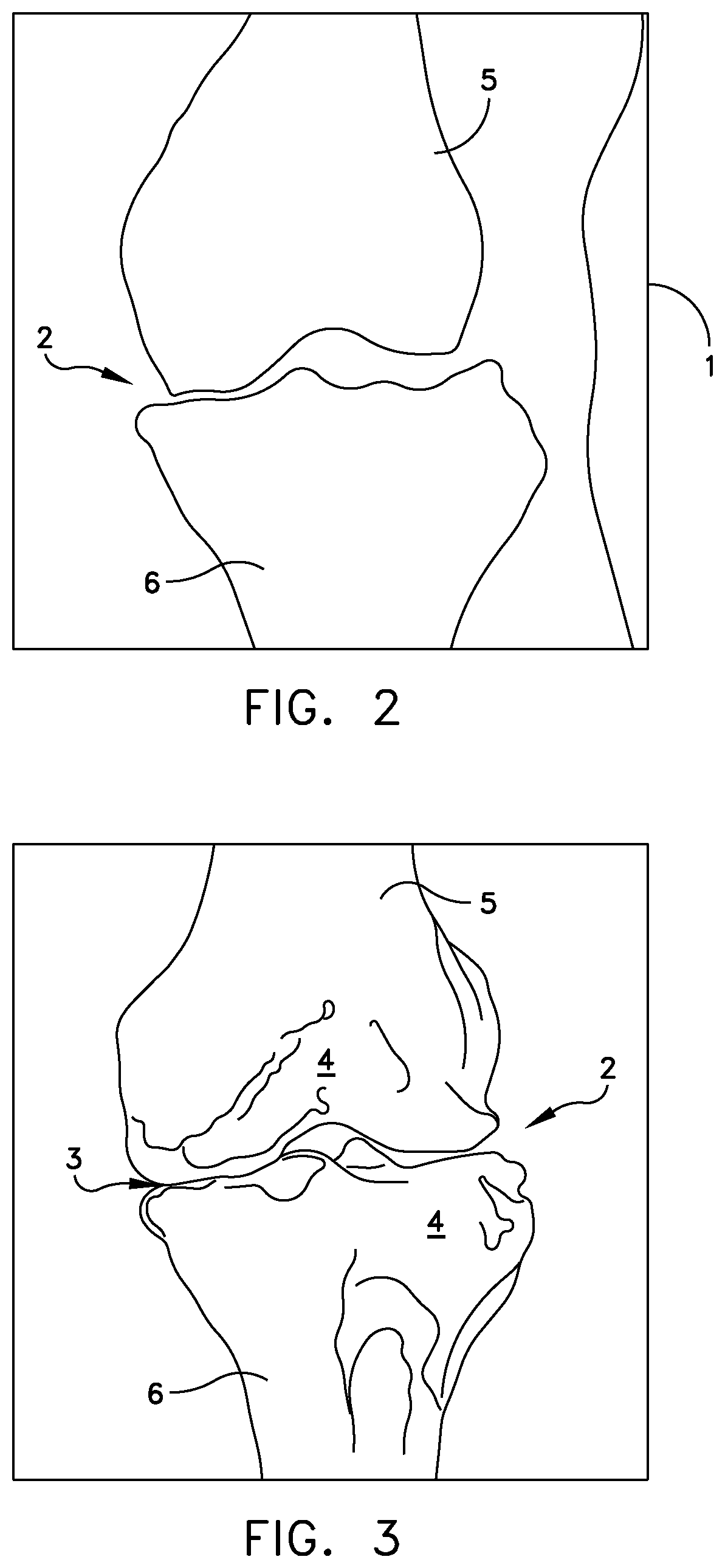 Patent US11779347 Figure 2 – System for forming a patient specific surgical guide mount