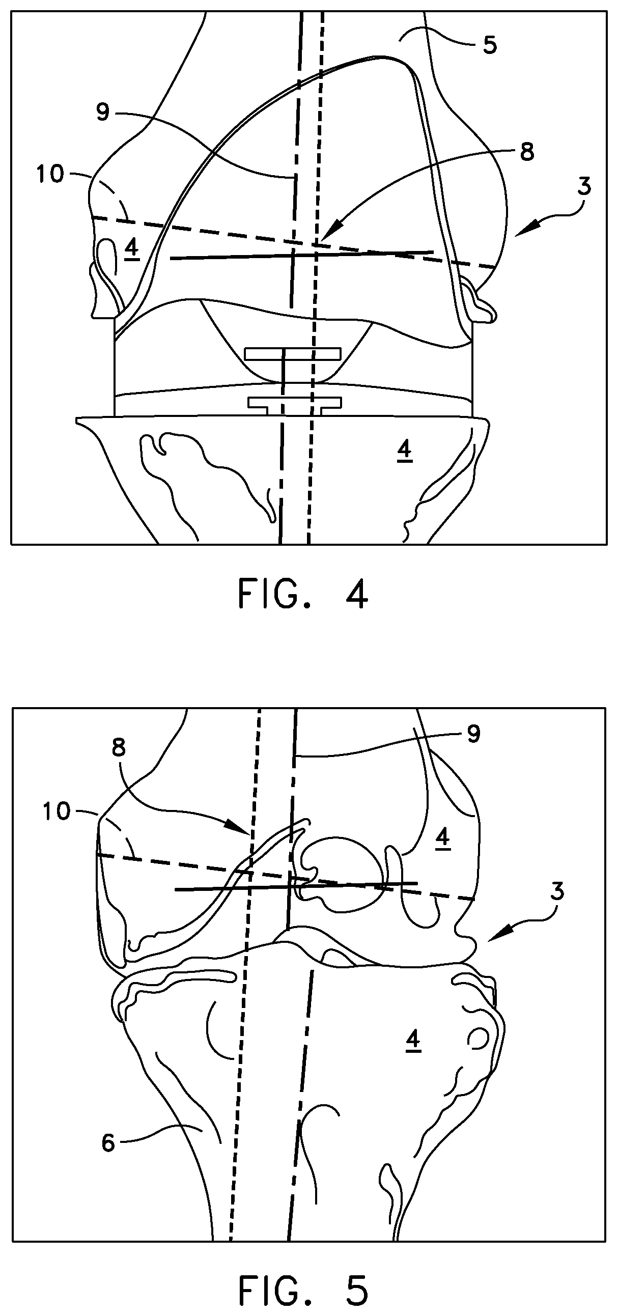 Patent US11779347 Figure 3 – System for forming a patient specific surgical guide mount
