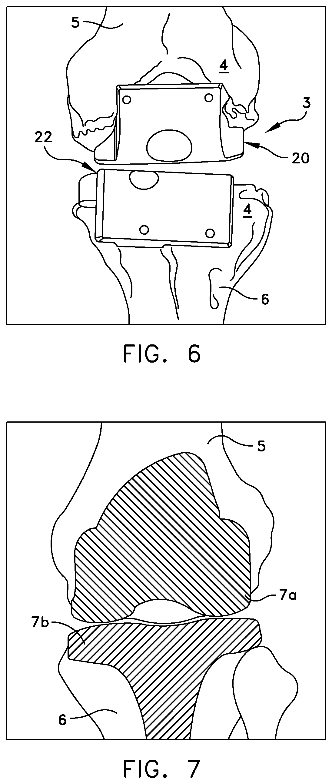 Patent US11779347 Figure 4 – System for forming a patient specific surgical guide mount