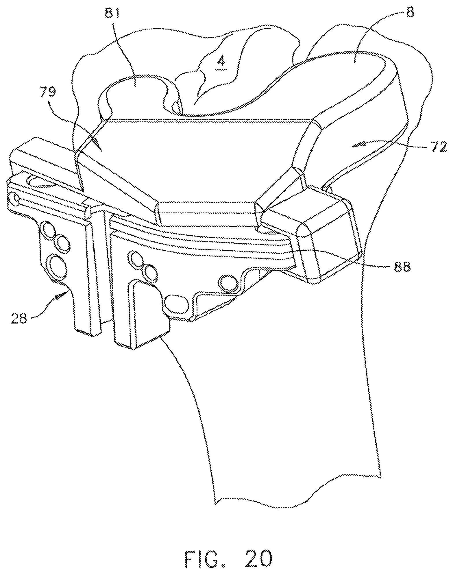 Patent US11779347 Figure 16 – System for forming a patient specific surgical guide mount