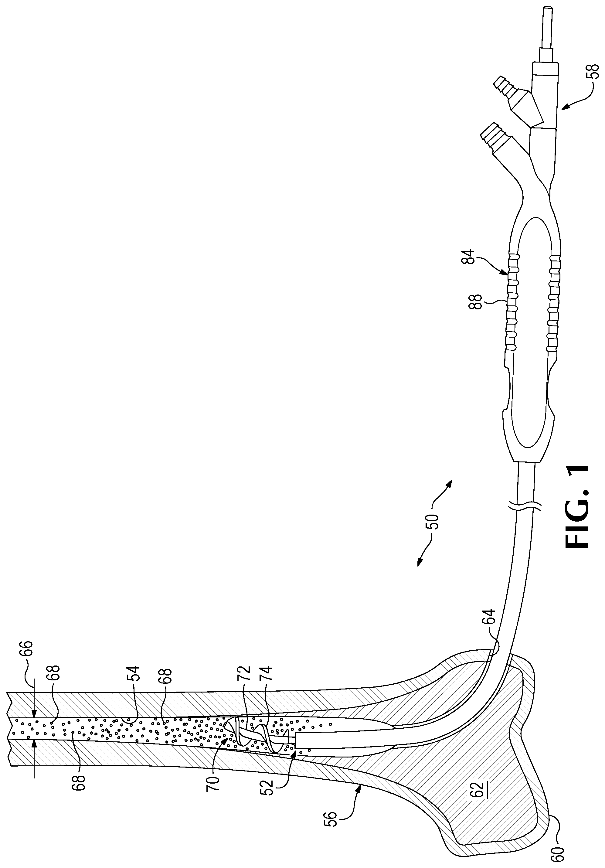 Patent US11779350 Figure 1 – Bone harvesting system