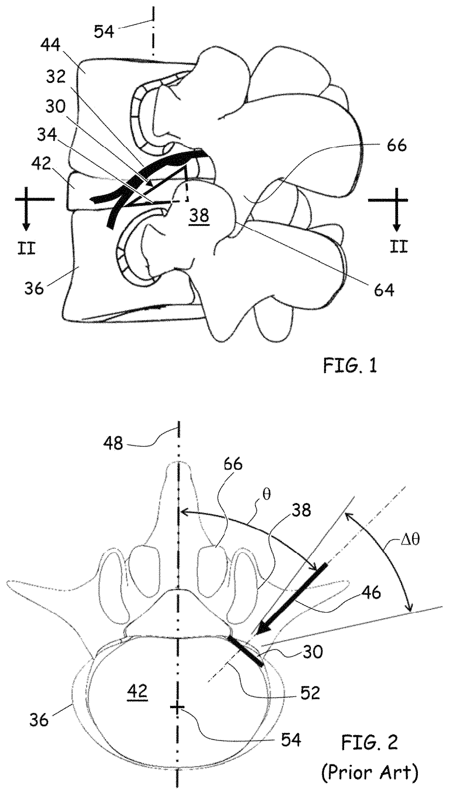 Patent US11779352 Figure 1 – Trans-facet oblique lateral lumbar interbody fusion