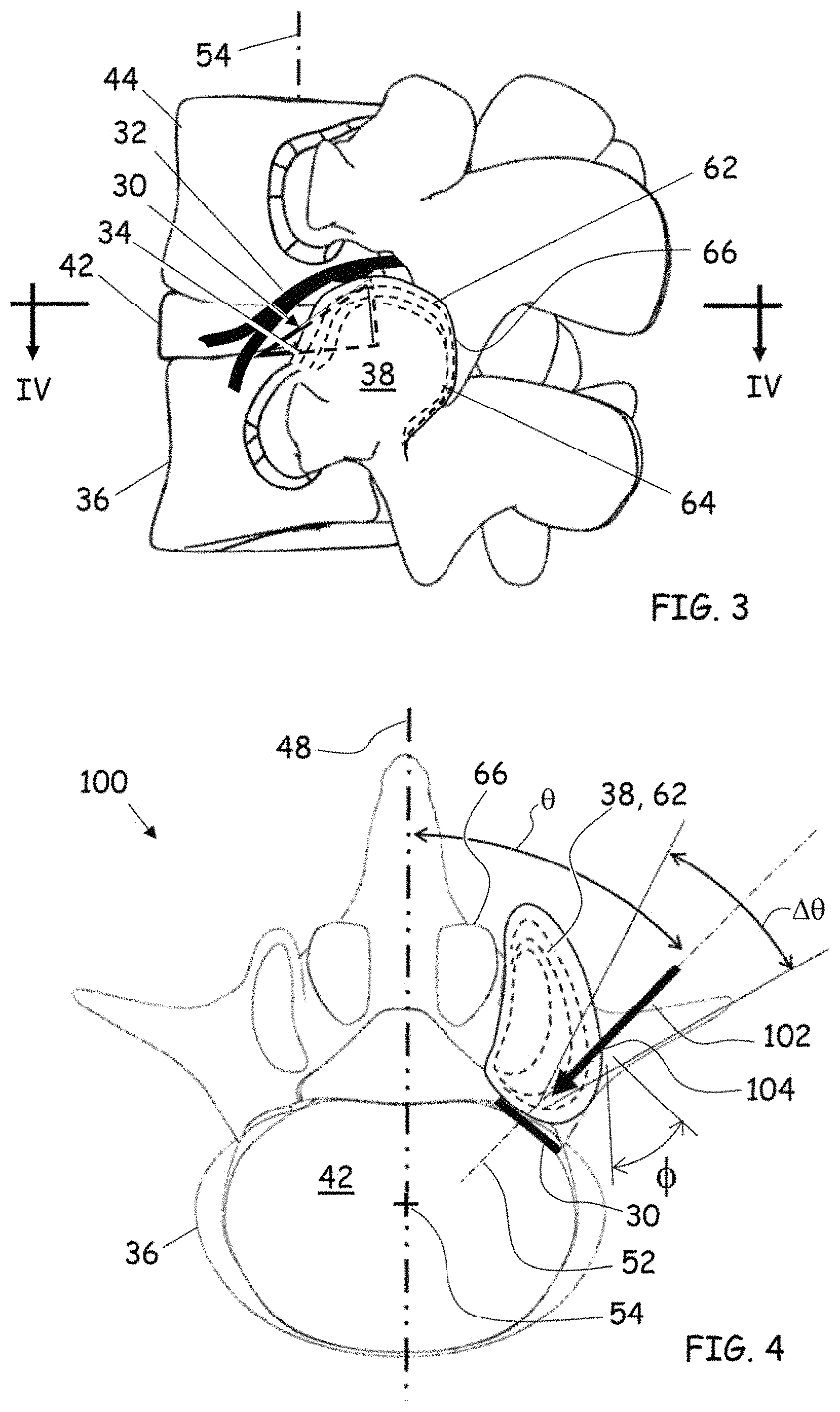 Patent US11779352 Figure 2 – Trans-facet oblique lateral lumbar interbody fusion