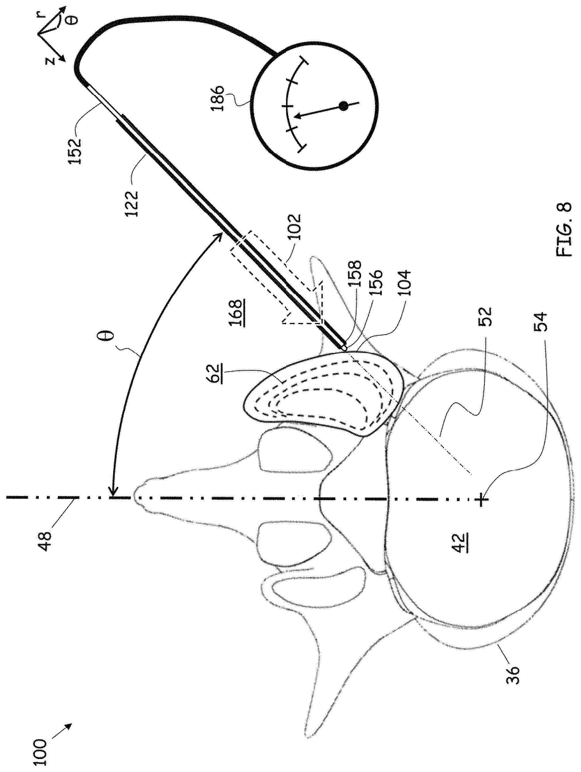 Patent US11779352 Figure 5 – Trans-facet oblique lateral lumbar interbody fusion