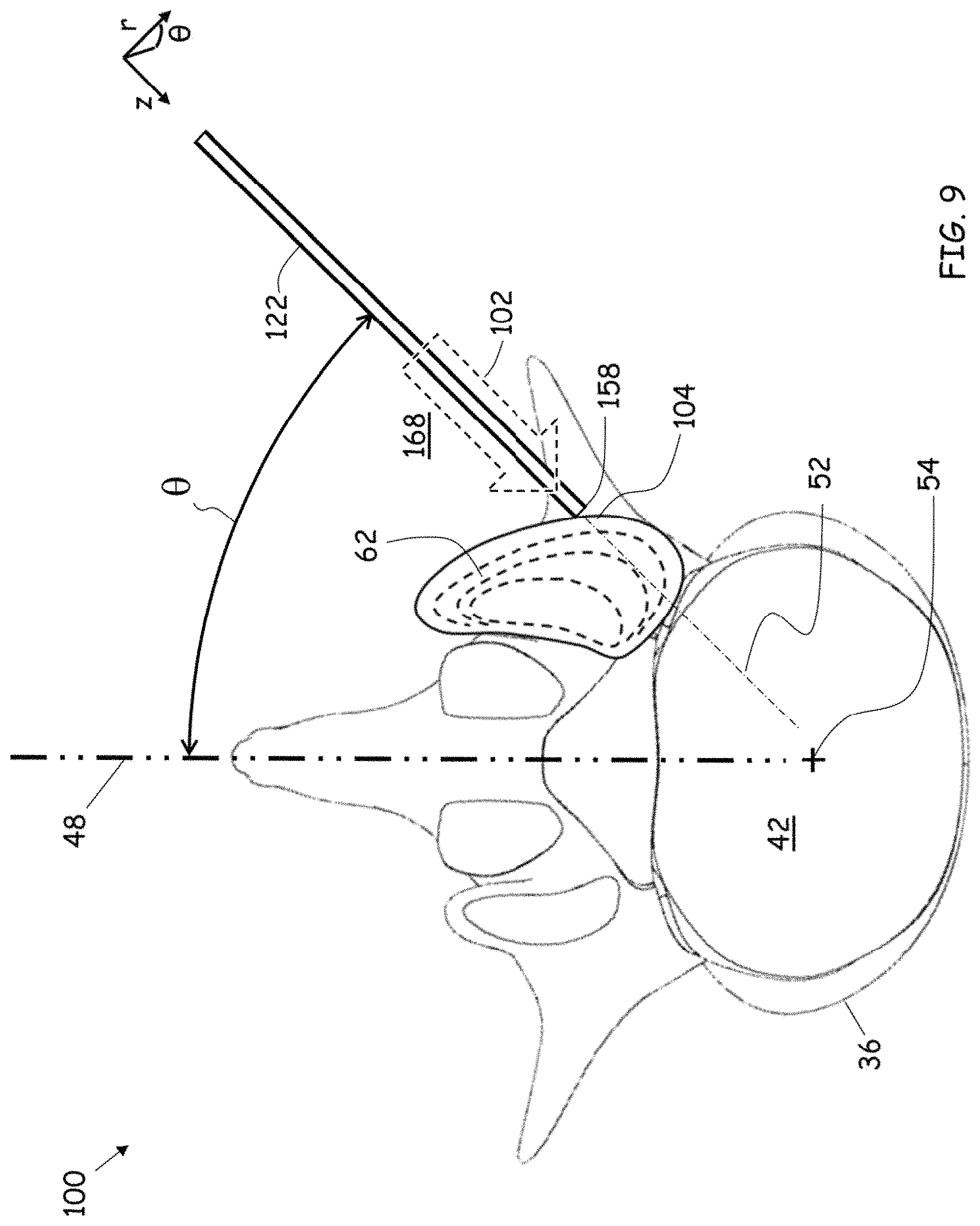Patent US11779352 Figure 6 – Trans-facet oblique lateral lumbar interbody fusion