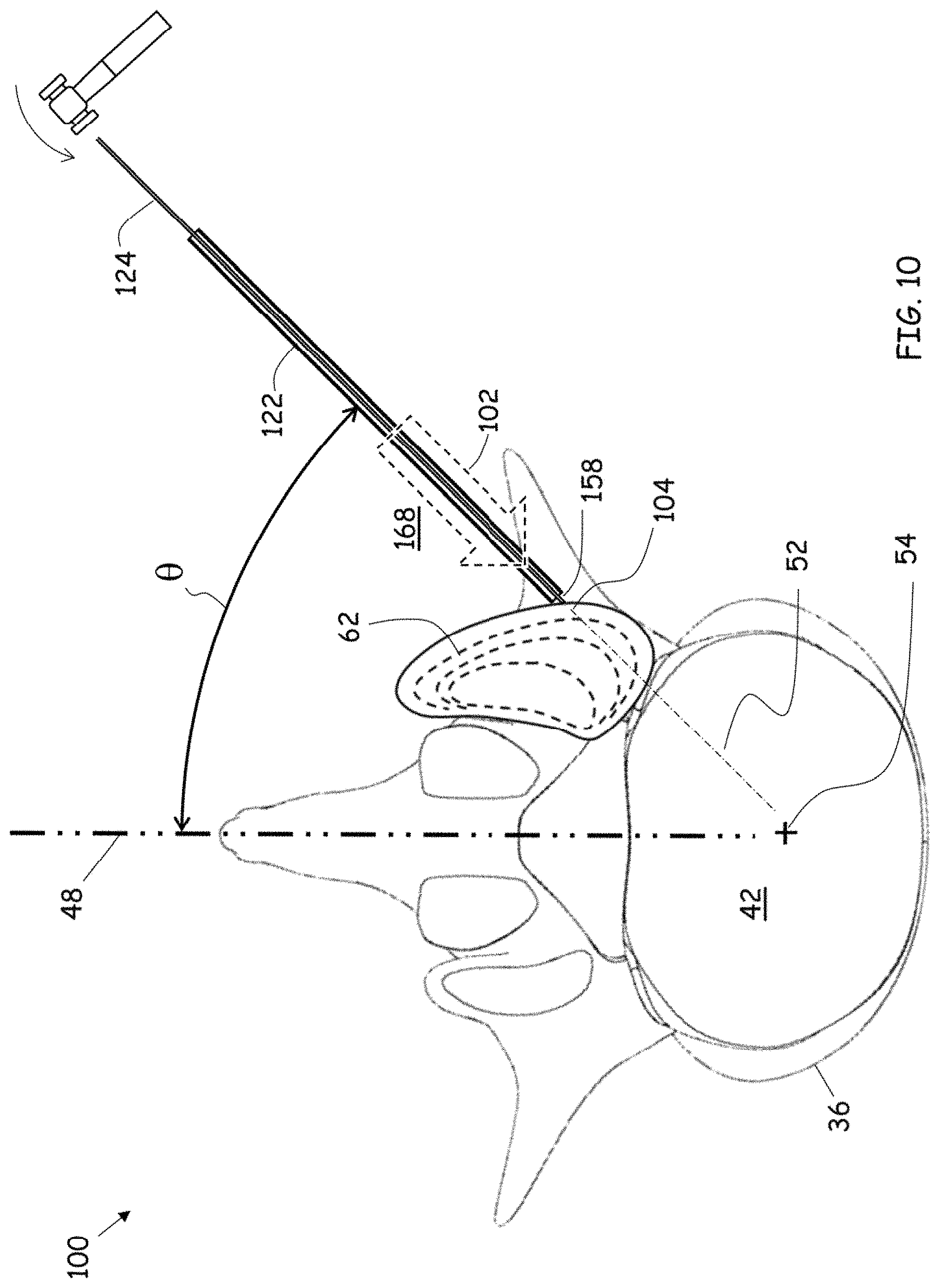 Patent US11779352 Figure 7 – Trans-facet oblique lateral lumbar interbody fusion