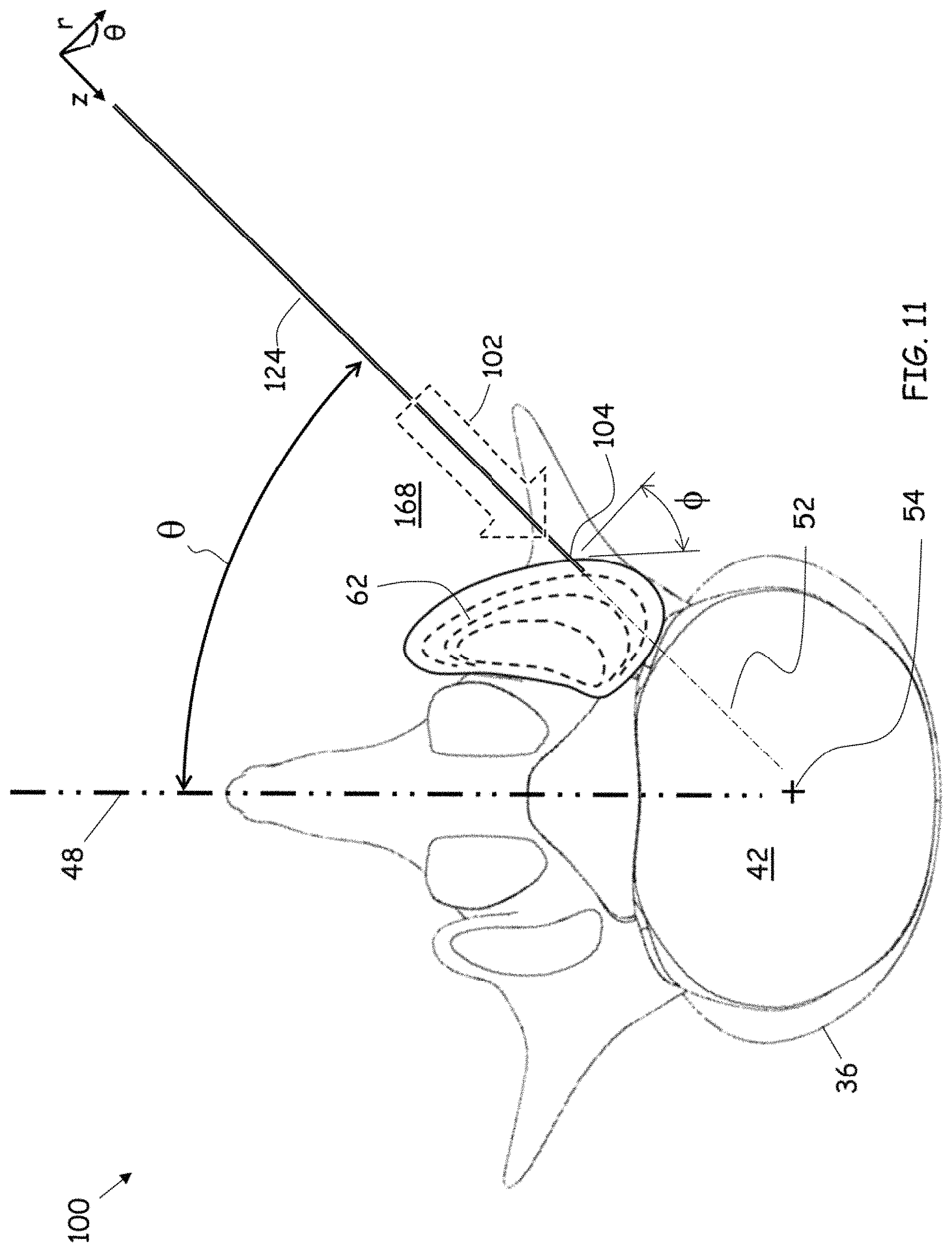 Patent US11779352 Figure 8 – Trans-facet oblique lateral lumbar interbody fusion