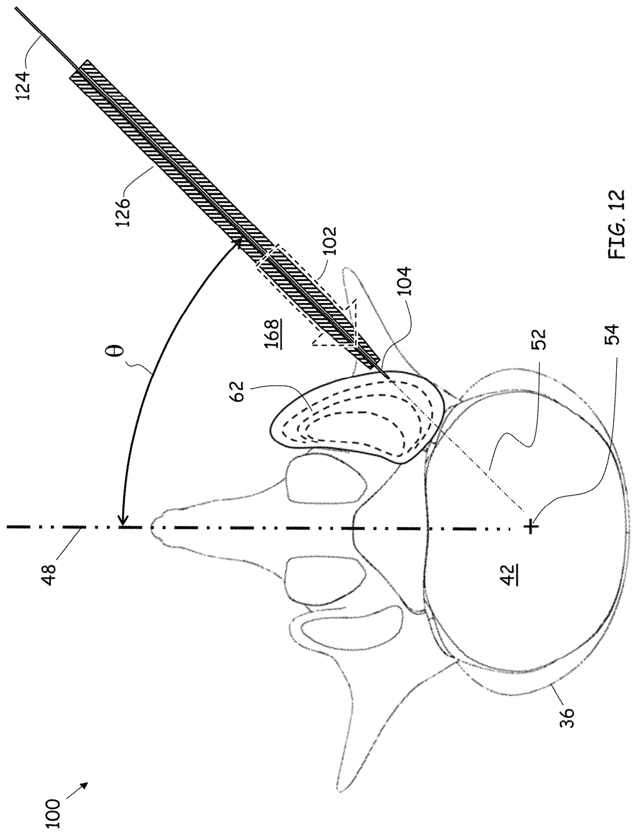 Patent US11779352 Figure 9 – Trans-facet oblique lateral lumbar interbody fusion