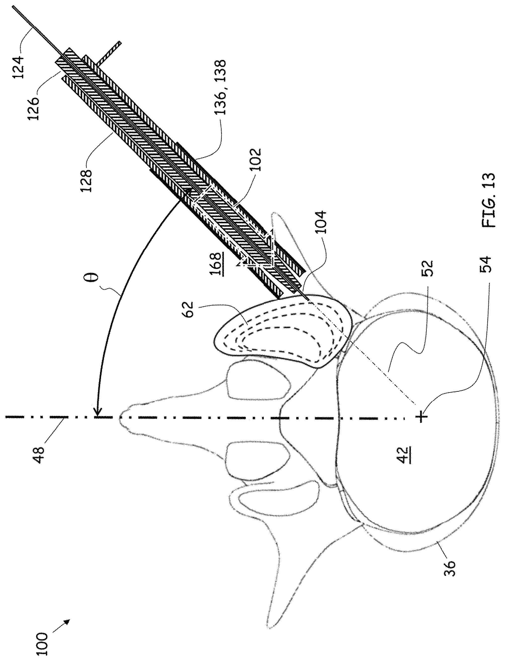 Patent US11779352 Figure 10 – Trans-facet oblique lateral lumbar interbody fusion