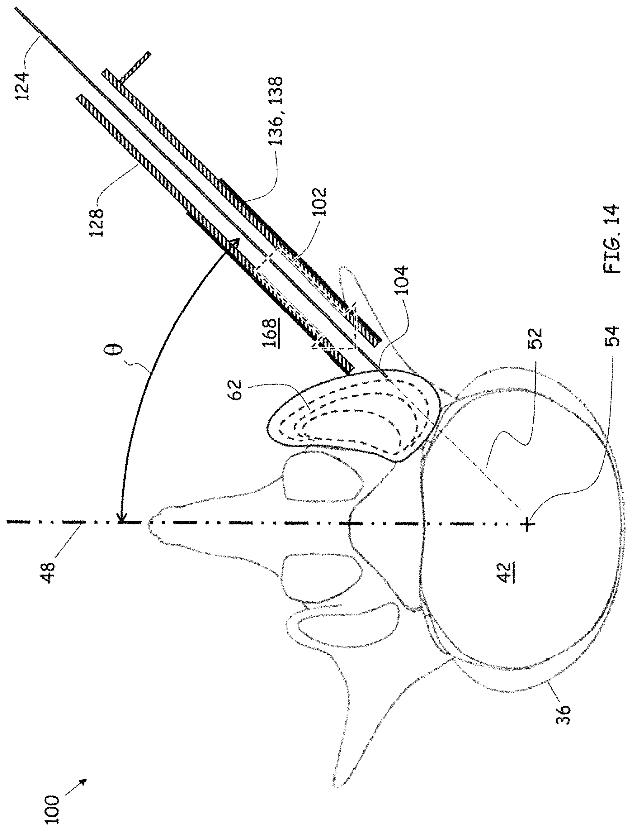 Patent US11779352 Figure 11 – Trans-facet oblique lateral lumbar interbody fusion
