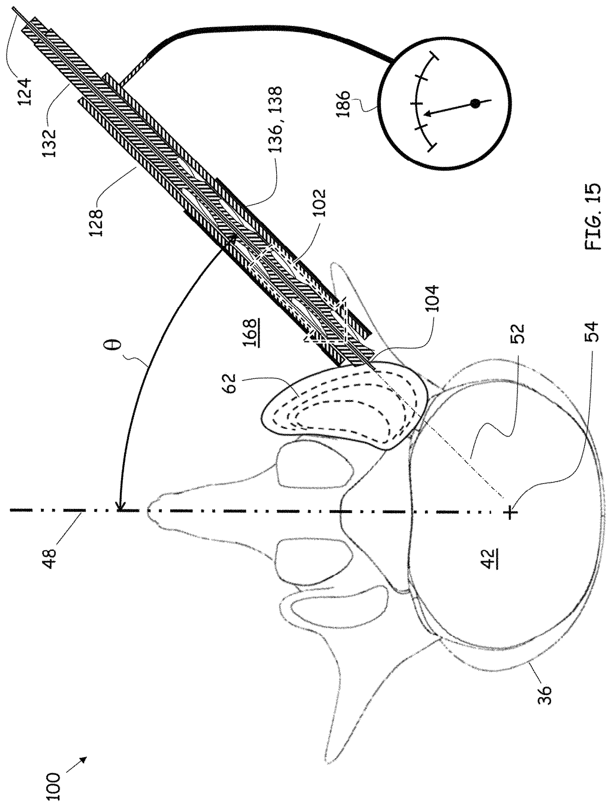 Patent US11779352 Figure 12 – Trans-facet oblique lateral lumbar interbody fusion