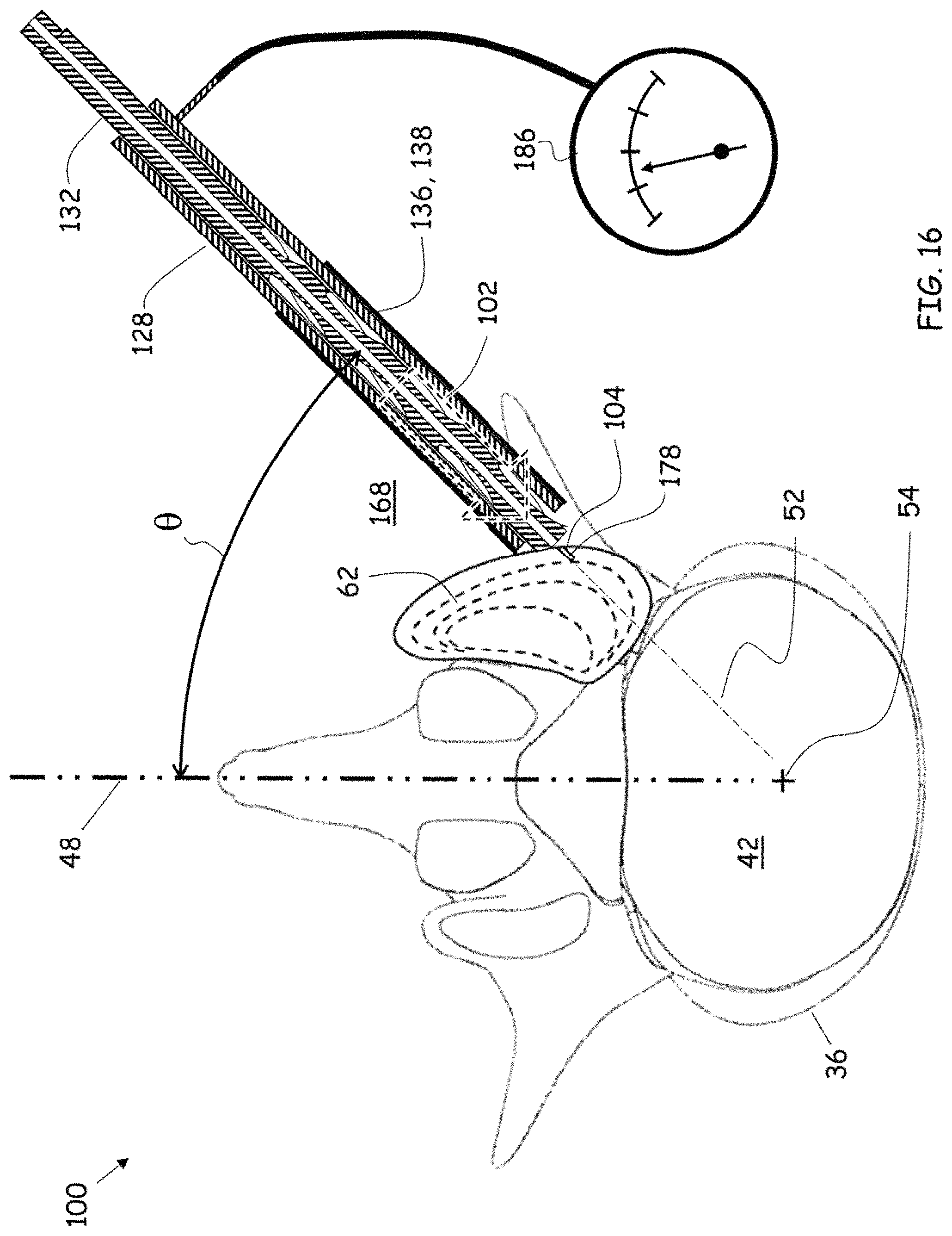 Patent US11779352 Figure 13 – Trans-facet oblique lateral lumbar interbody fusion