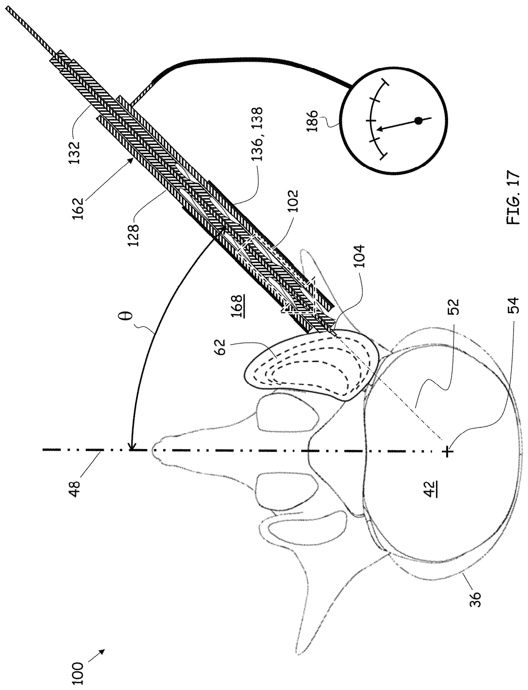 Patent US11779352 Figure 14 – Trans-facet oblique lateral lumbar interbody fusion