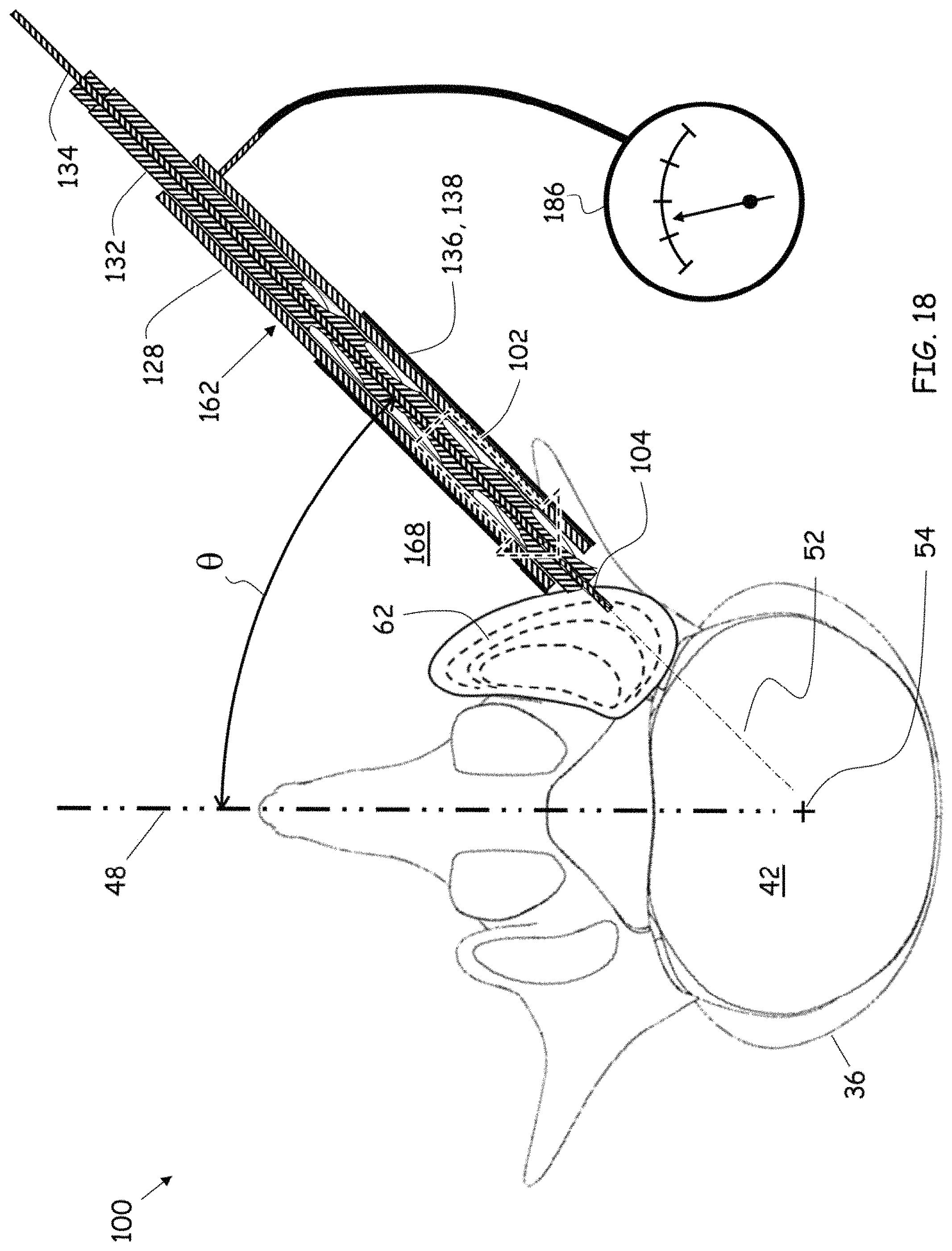 Patent US11779352 Figure 15 – Trans-facet oblique lateral lumbar interbody fusion