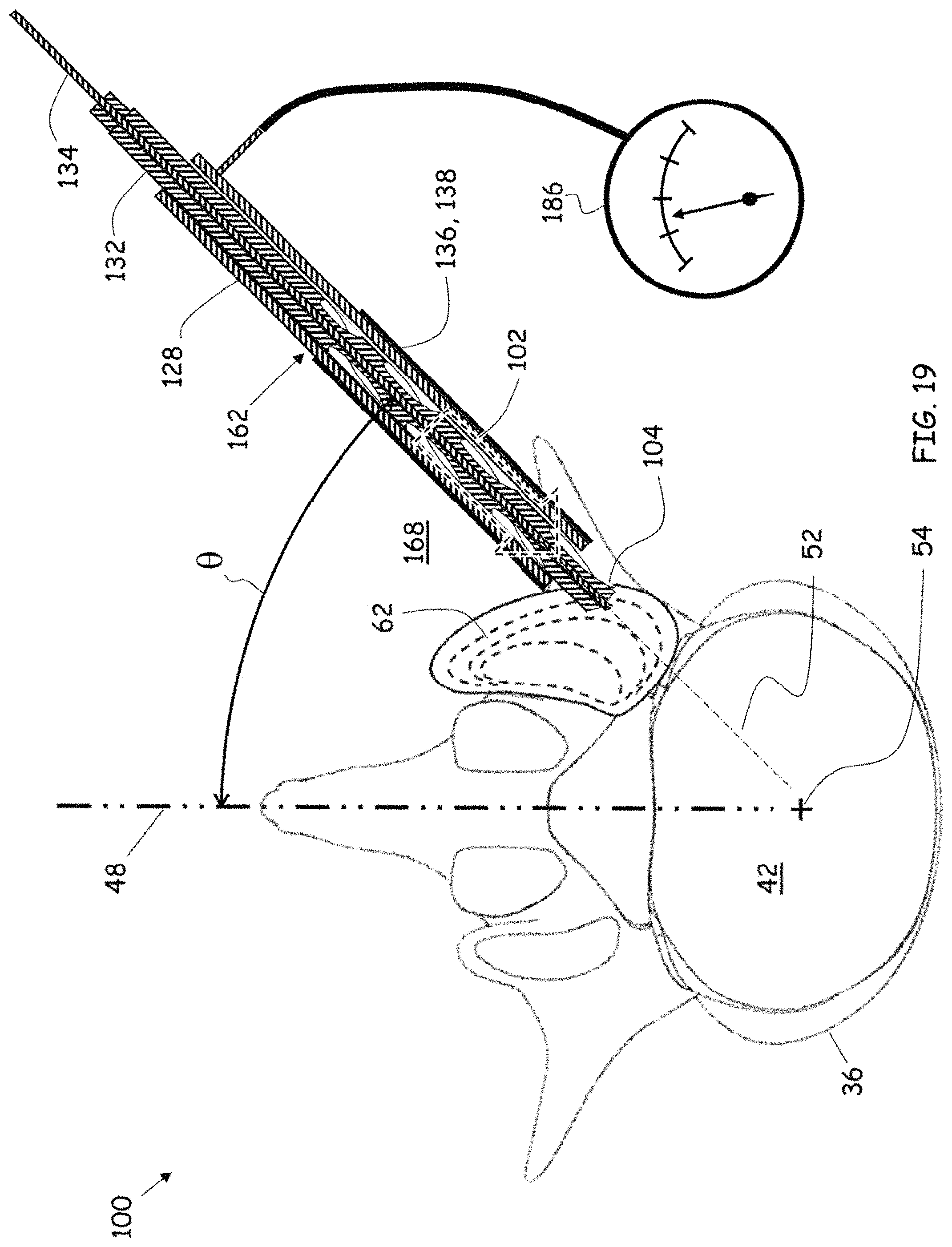 Patent US11779352 Figure 16 – Trans-facet oblique lateral lumbar interbody fusion