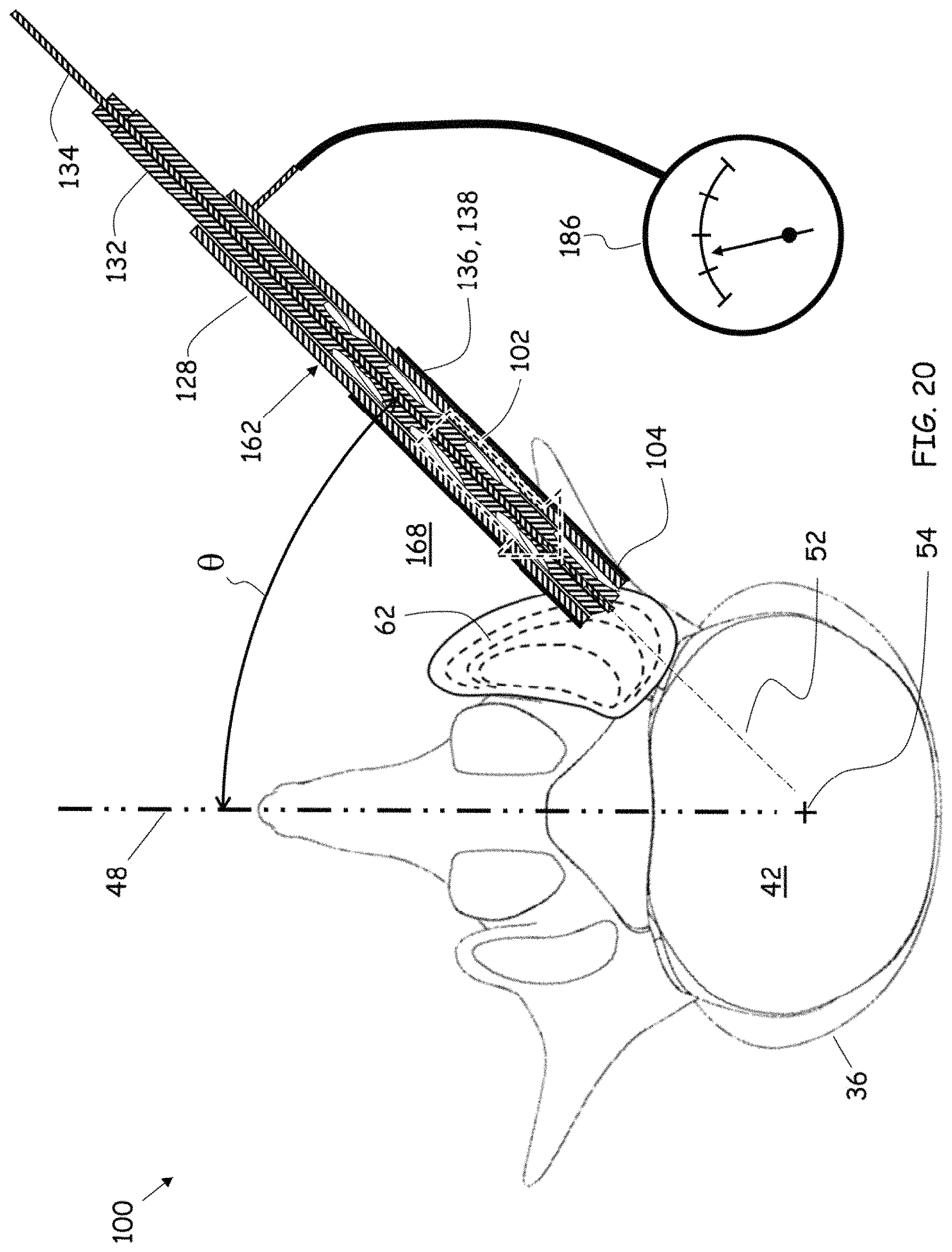 Patent US11779352 Figure 17 – Trans-facet oblique lateral lumbar interbody fusion