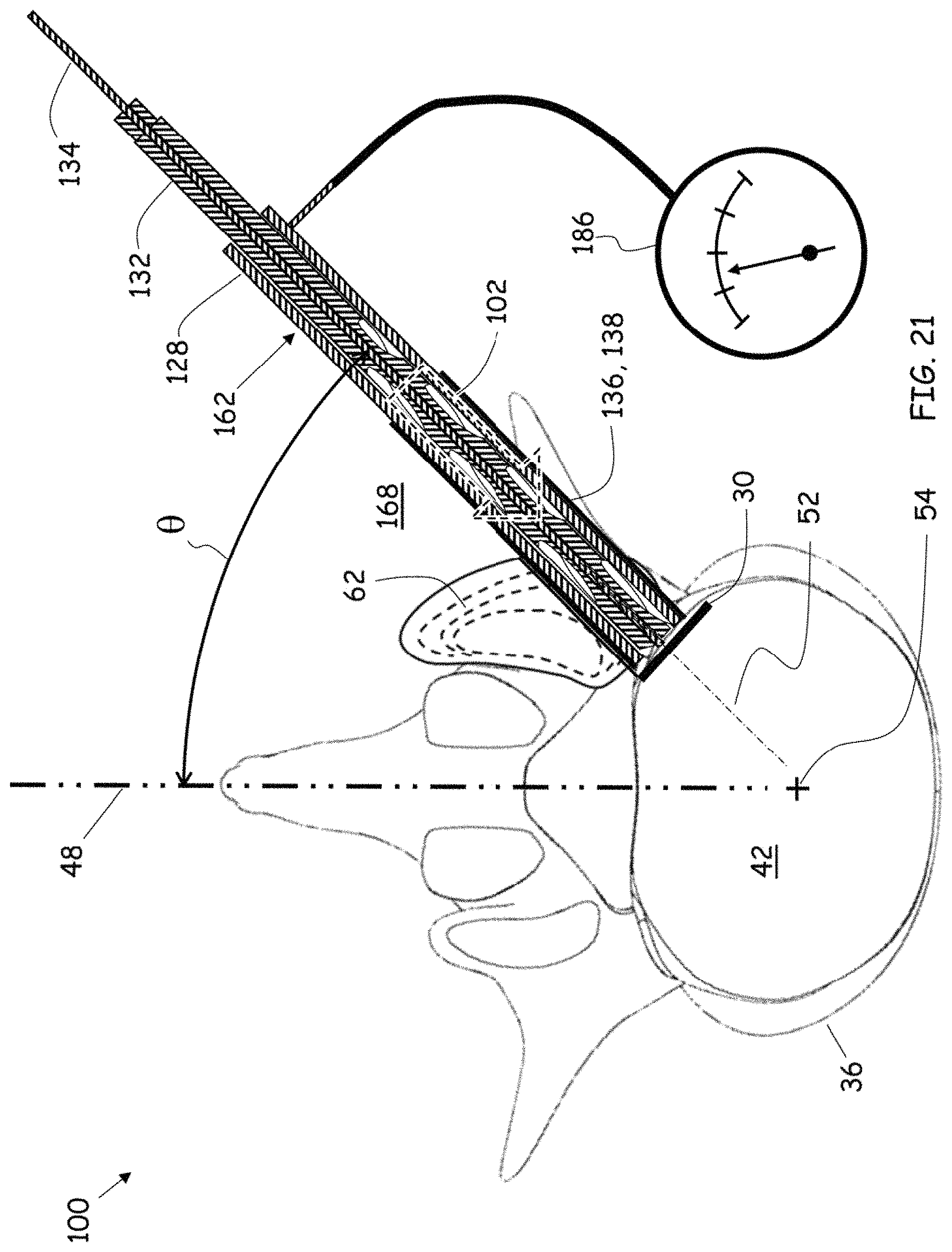 Patent US11779352 Figure 18 – Trans-facet oblique lateral lumbar interbody fusion