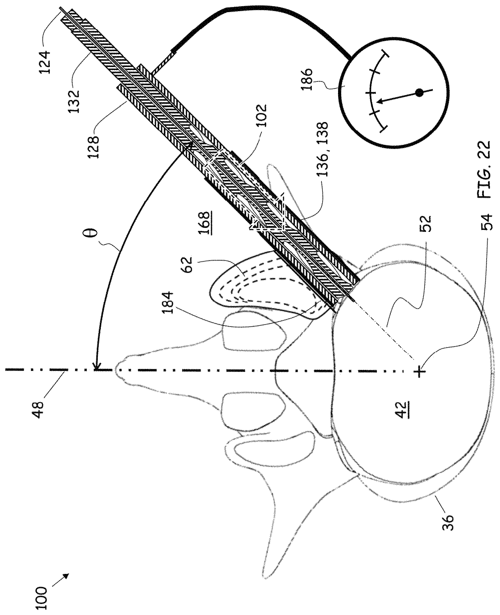 Patent US11779352 Figure 19 – Trans-facet oblique lateral lumbar interbody fusion