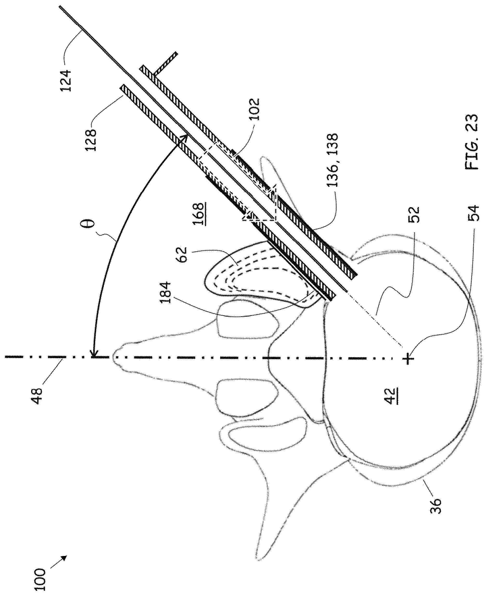 Patent US11779352 Figure 20 – Trans-facet oblique lateral lumbar interbody fusion