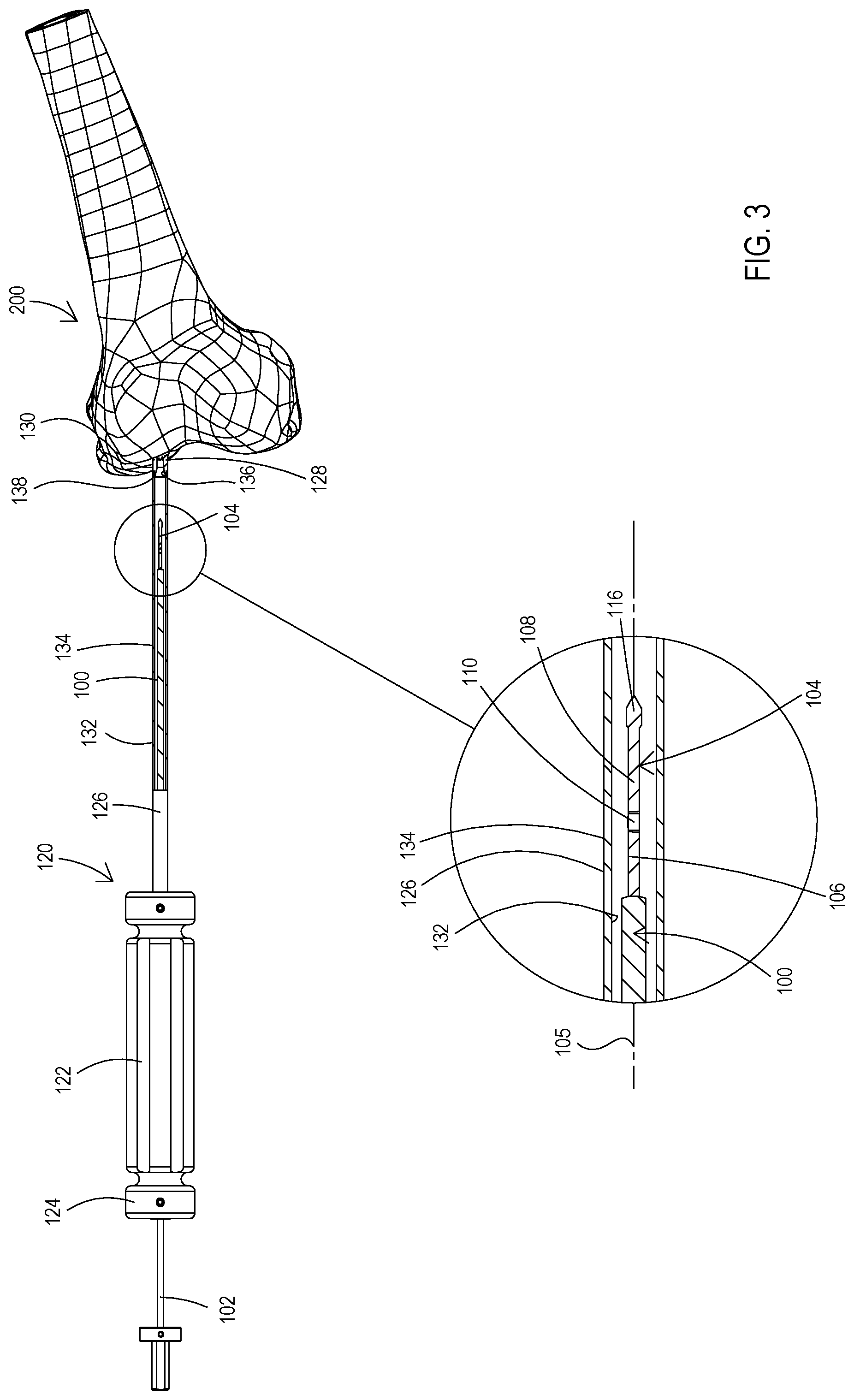 Patent US11779353 Figure 3 – Bone material removal device and a method for use thereof