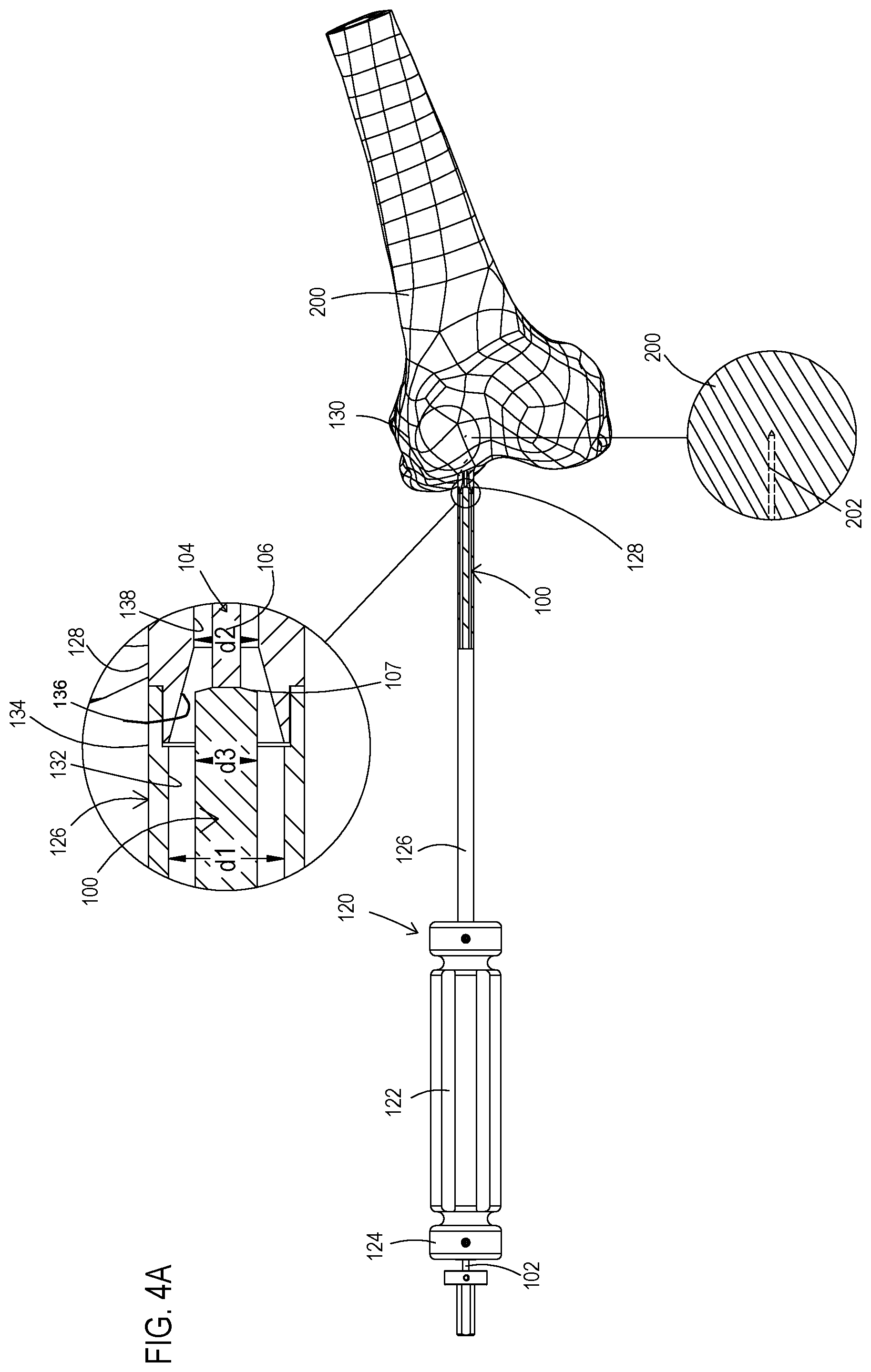 Patent US11779353 Figure 4 – Bone material removal device and a method for use thereof
