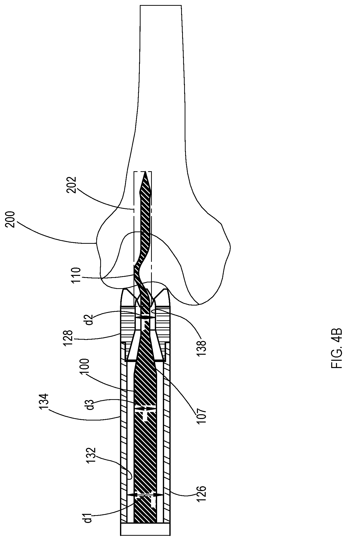 Patent US11779353 Figure 5 – Bone material removal device and a method for use thereof