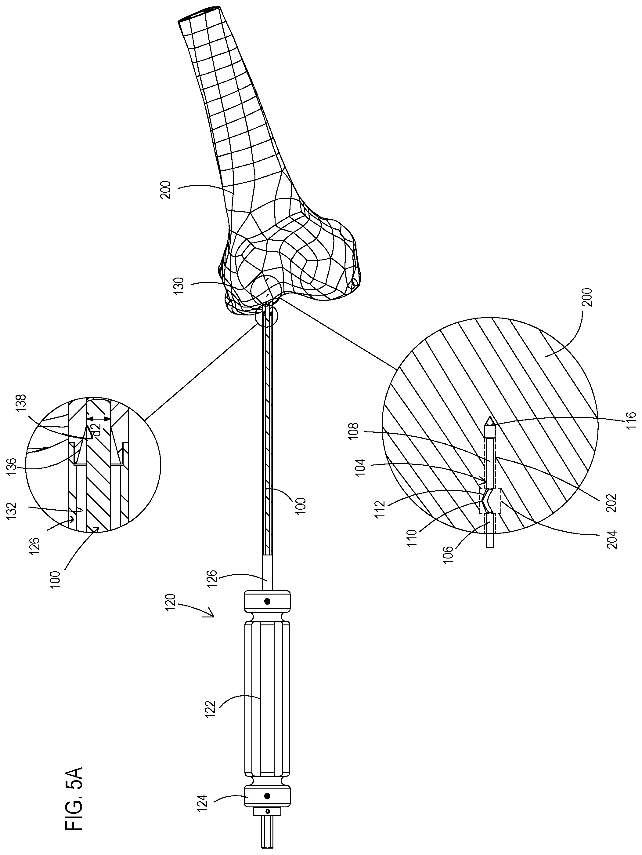 Patent US11779353 Figure 6 – Bone material removal device and a method for use thereof