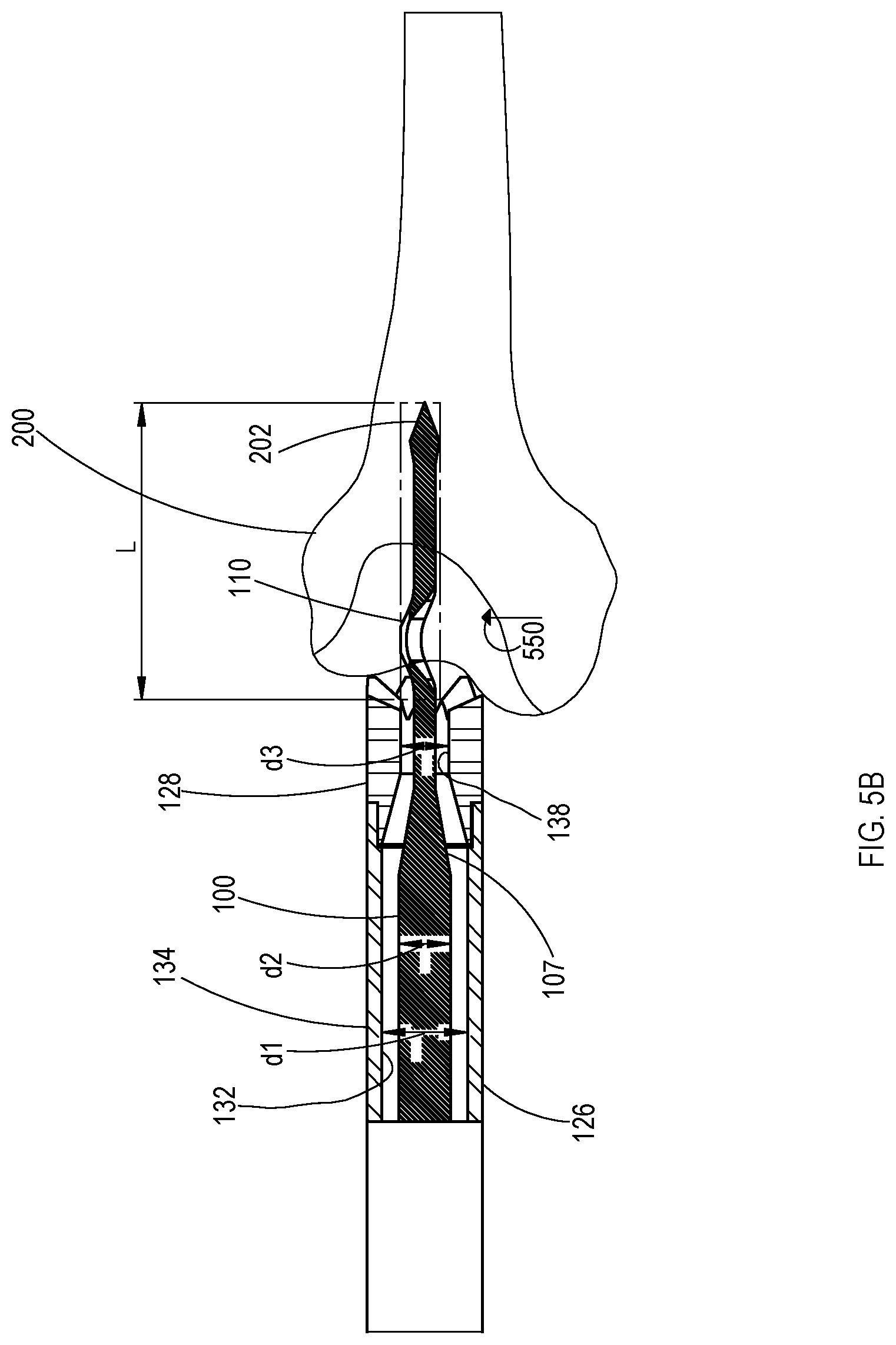 Patent US11779353 Figure 7 – Bone material removal device and a method for use thereof