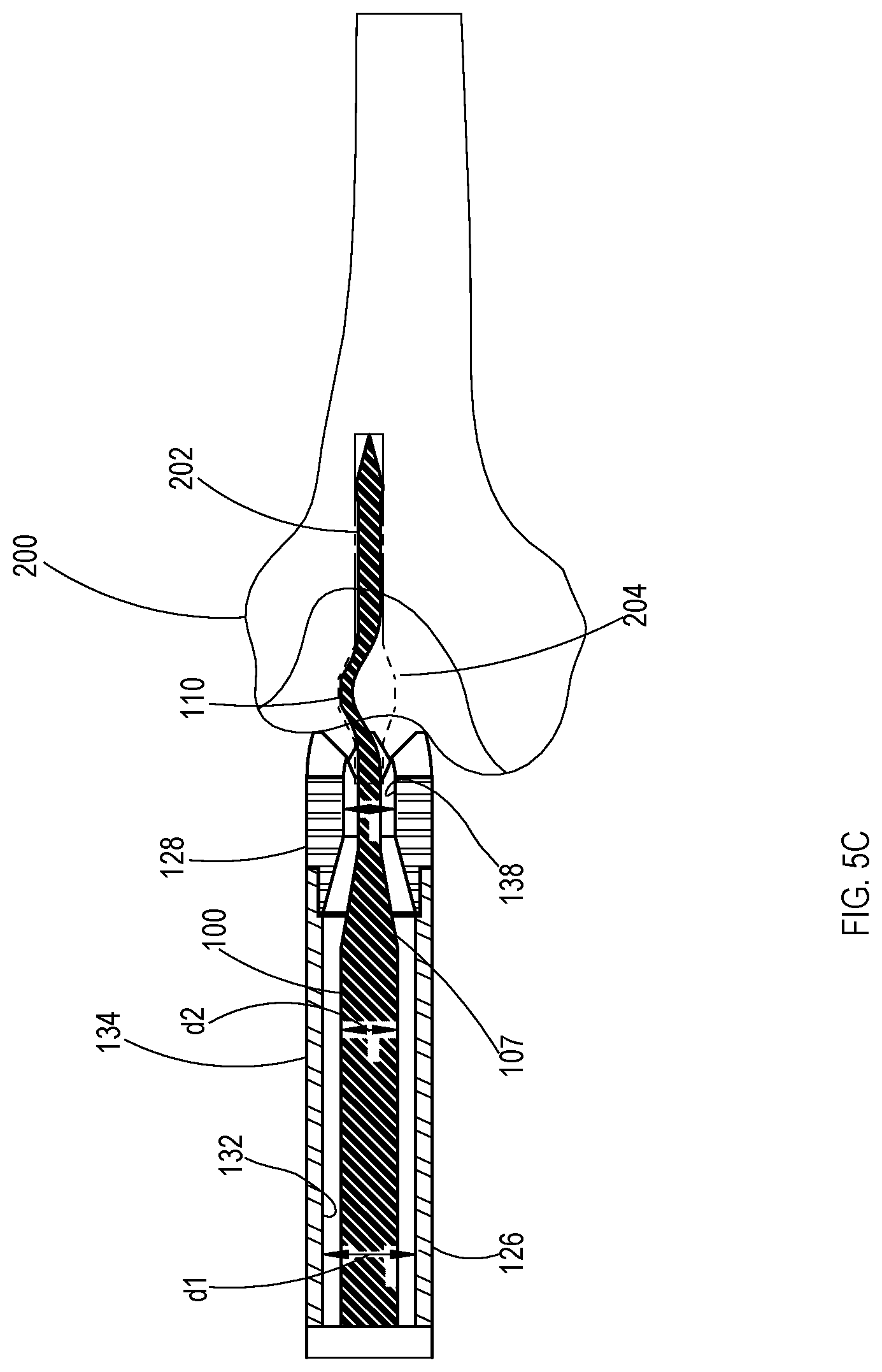 Patent US11779353 Figure 8 – Bone material removal device and a method for use thereof