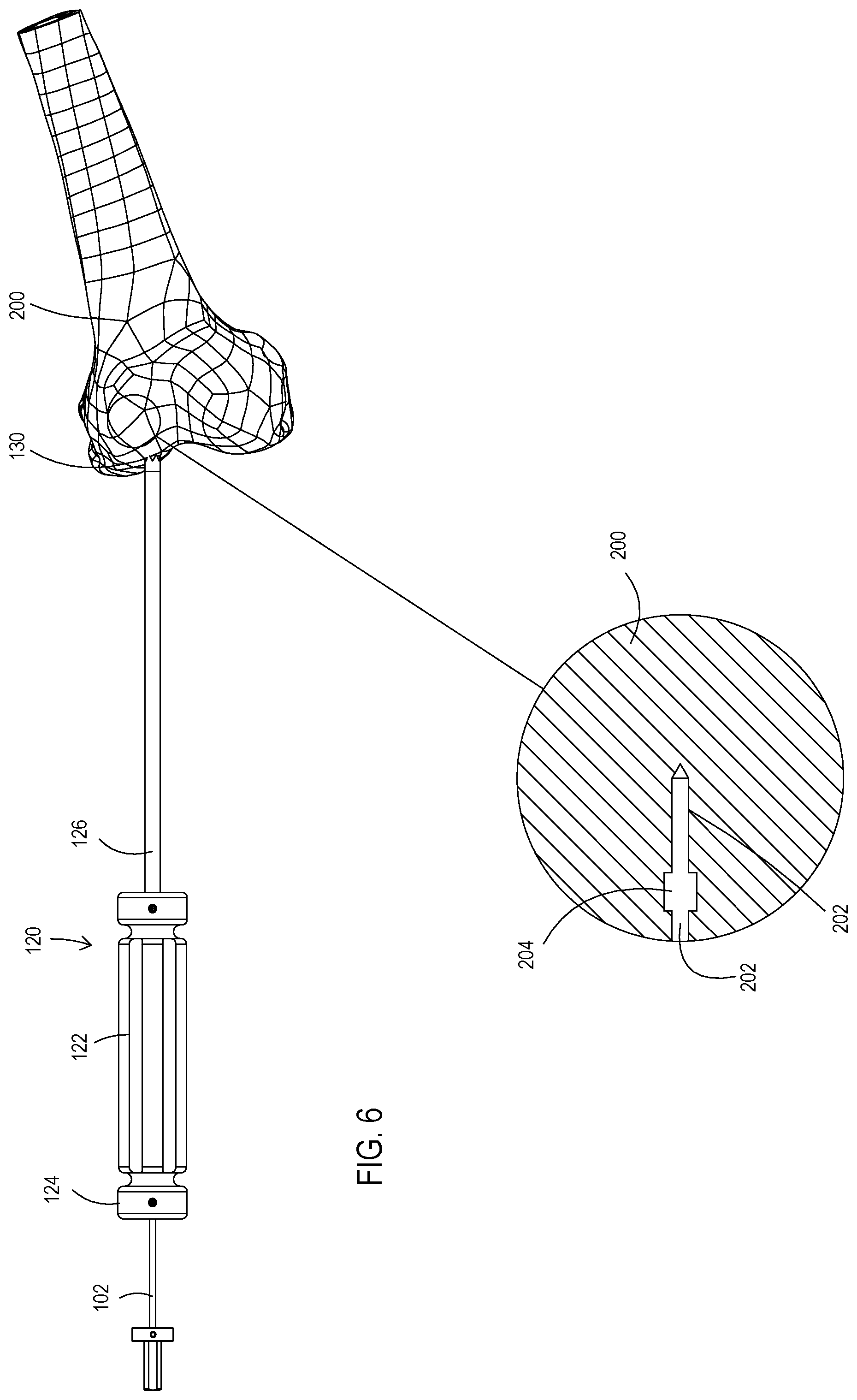 Patent US11779353 Figure 9 – Bone material removal device and a method for use thereof