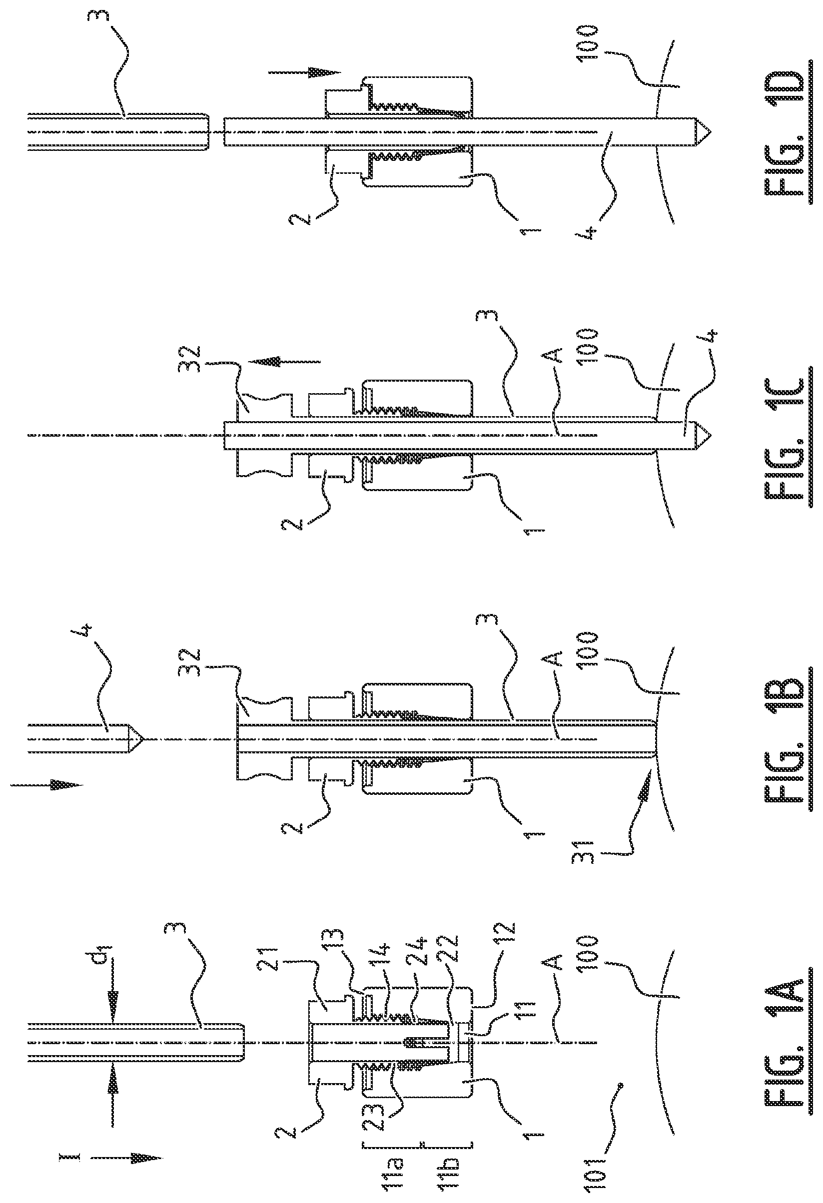 Patent US11779355 Figure 1 – System for connecting a connecting device, in particular a distractor, to a bone