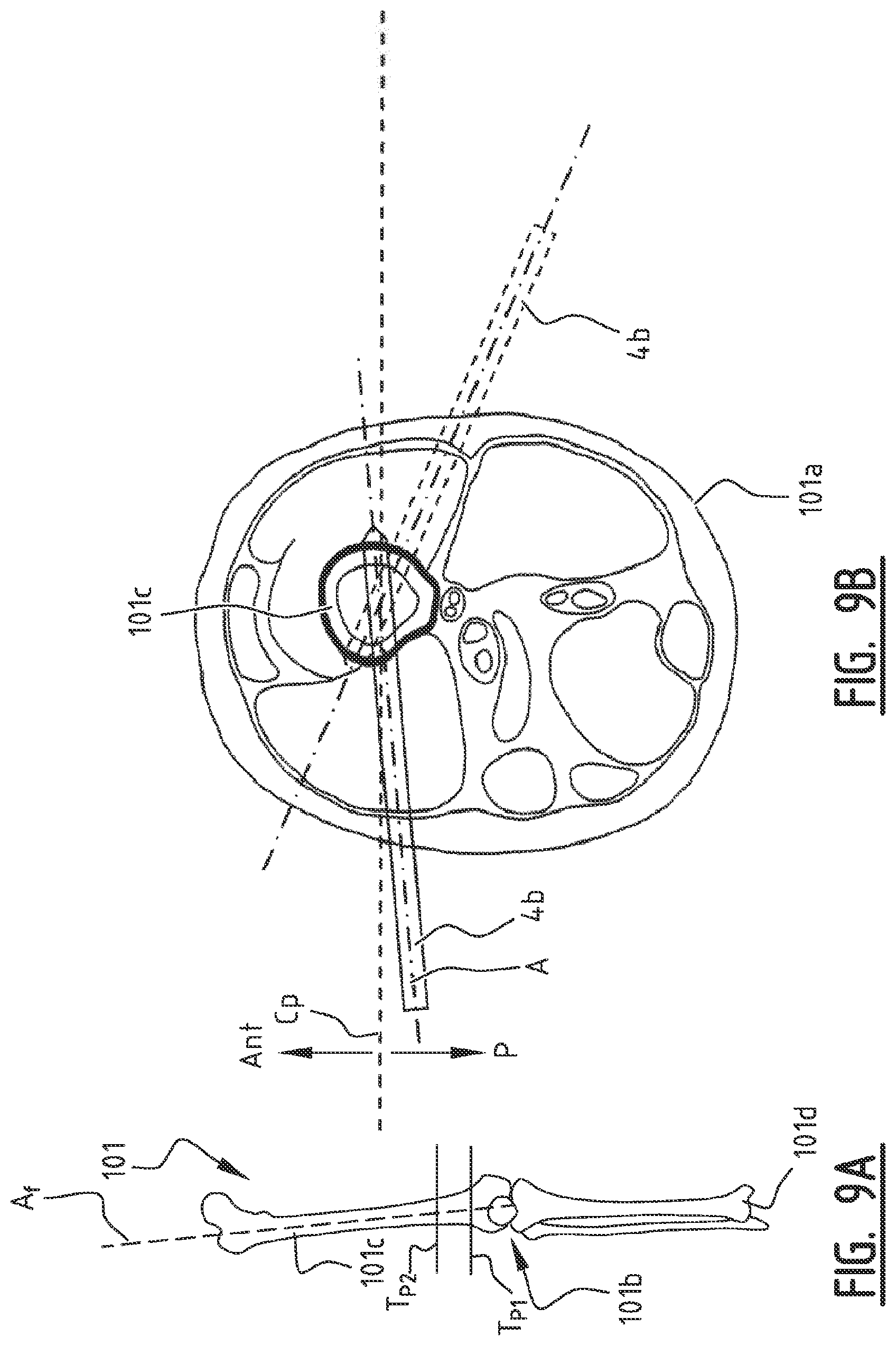 Patent US11779355 Figure 14 – System for connecting a connecting device, in particular a distractor, to a bone