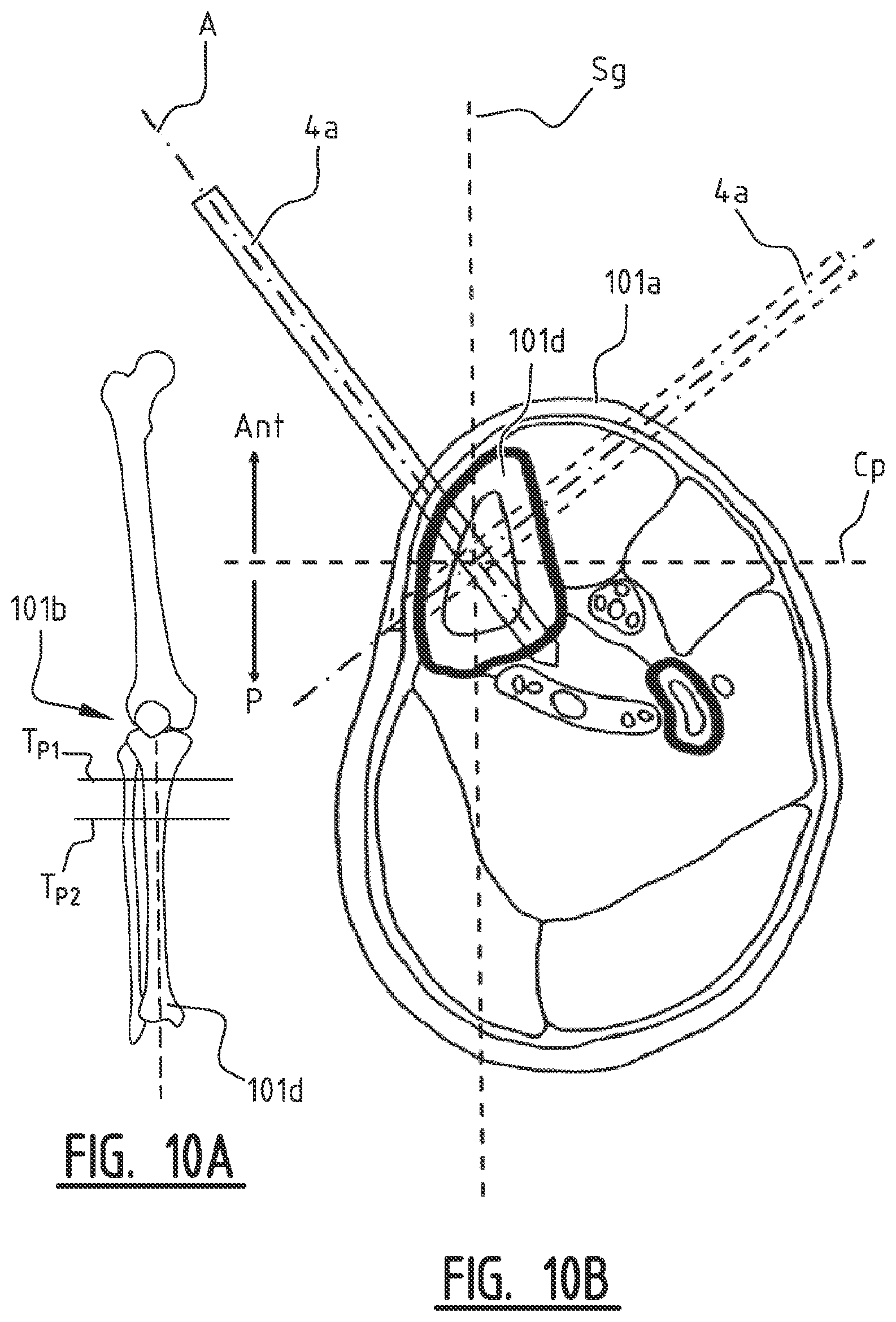 Patent US11779355 Figure 15 – System for connecting a connecting device, in particular a distractor, to a bone