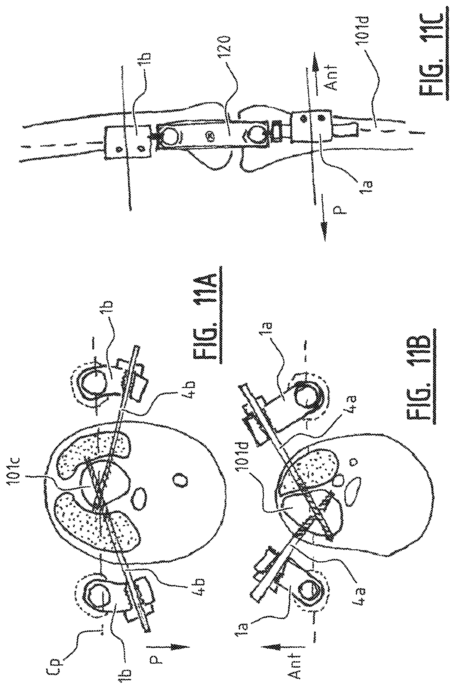Patent US11779355 Figure 16 – System for connecting a connecting device, in particular a distractor, to a bone