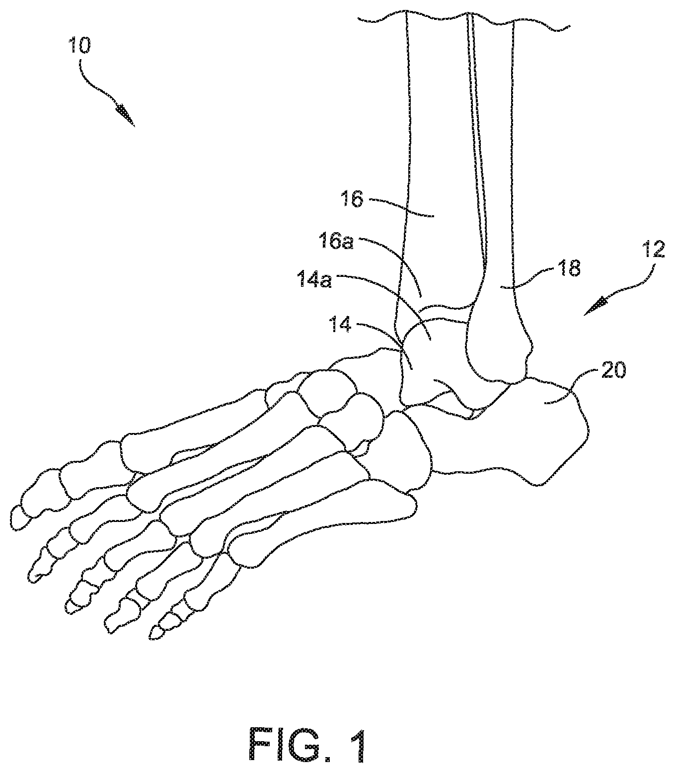 Patent US11779356 — Orthopedic surgical guide — Figure 1