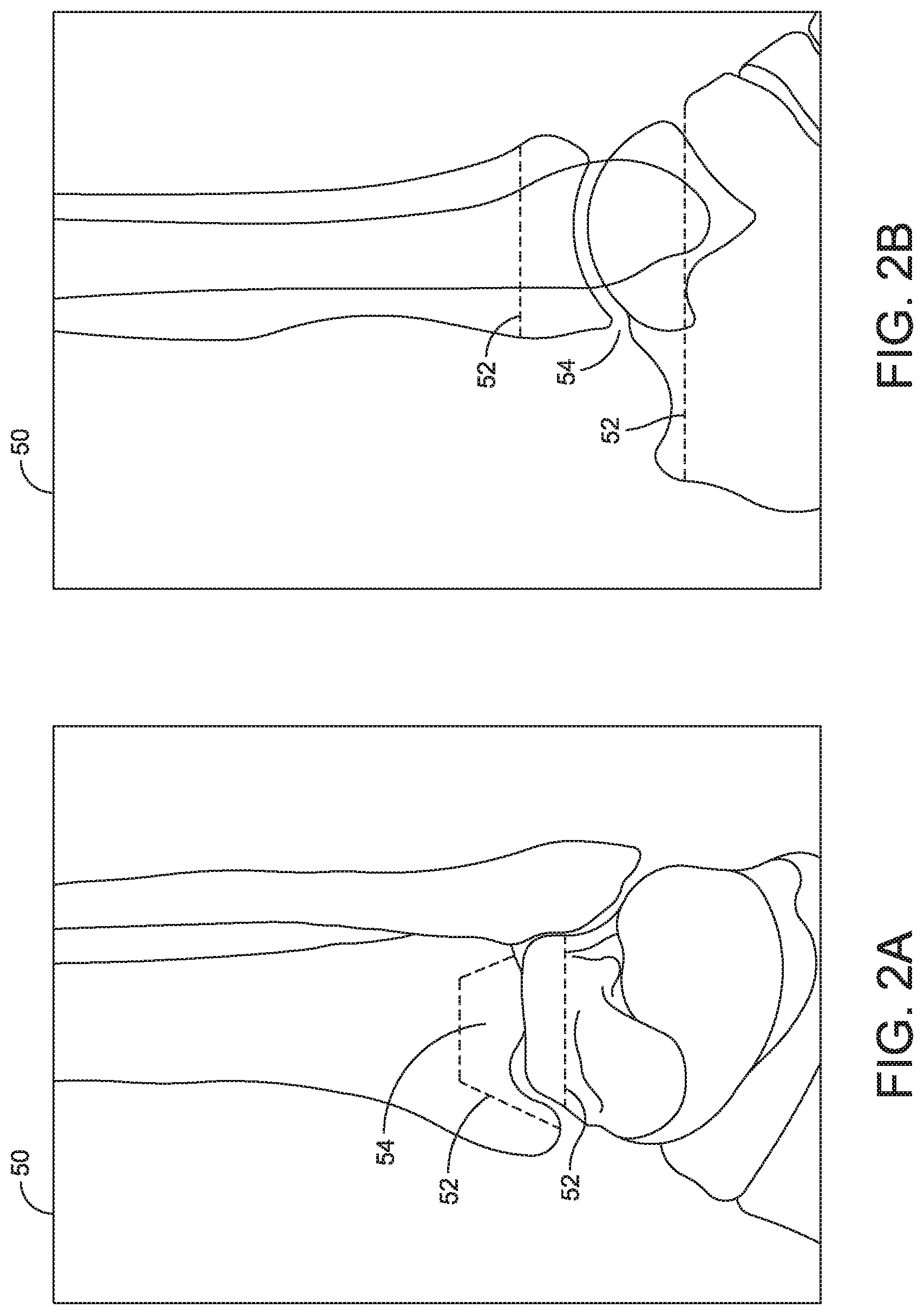 Patent US11779356 Figure 2 – Orthopedic surgical guide