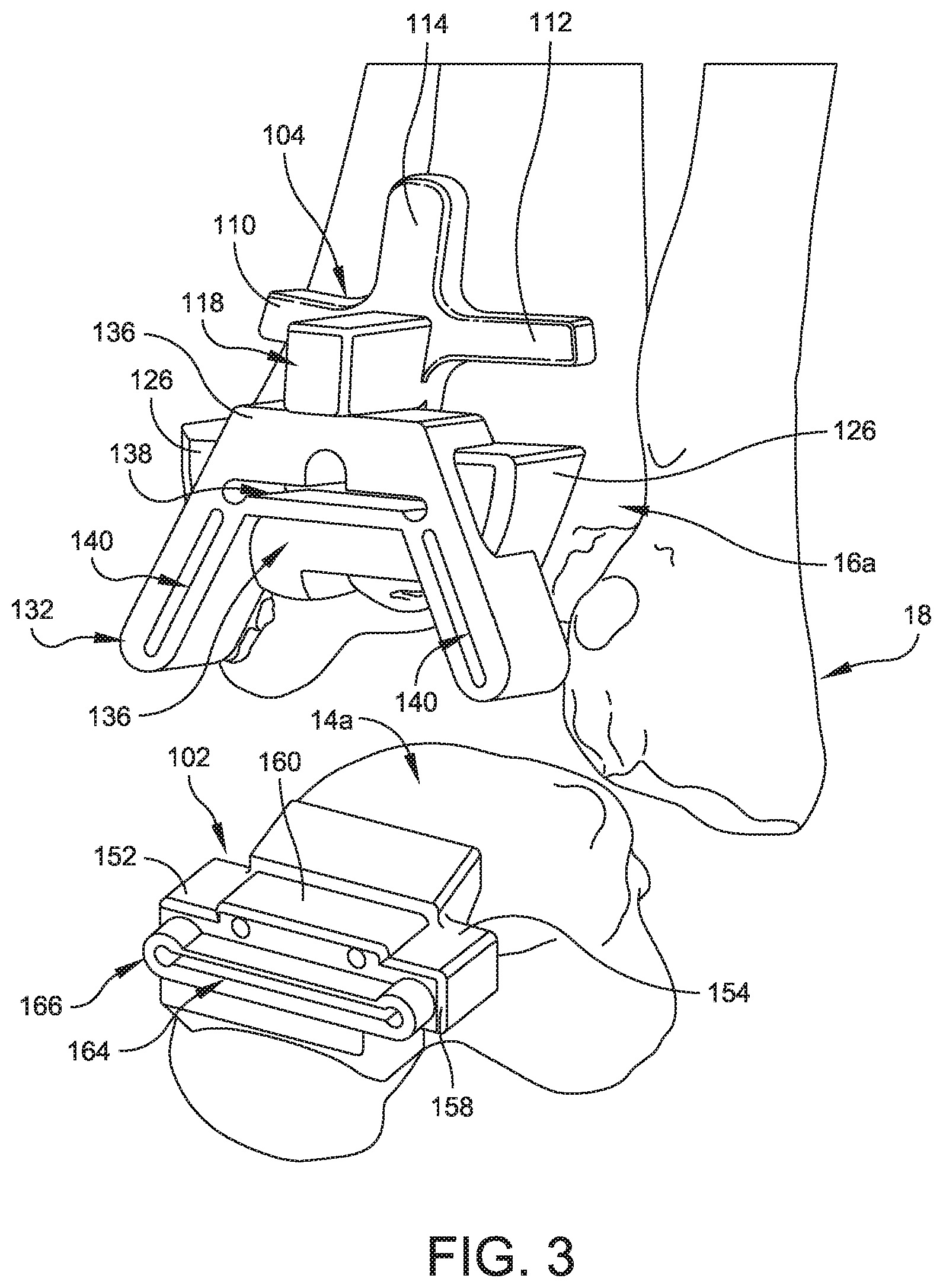 Patent US11779356 Figure 3 – Orthopedic surgical guide