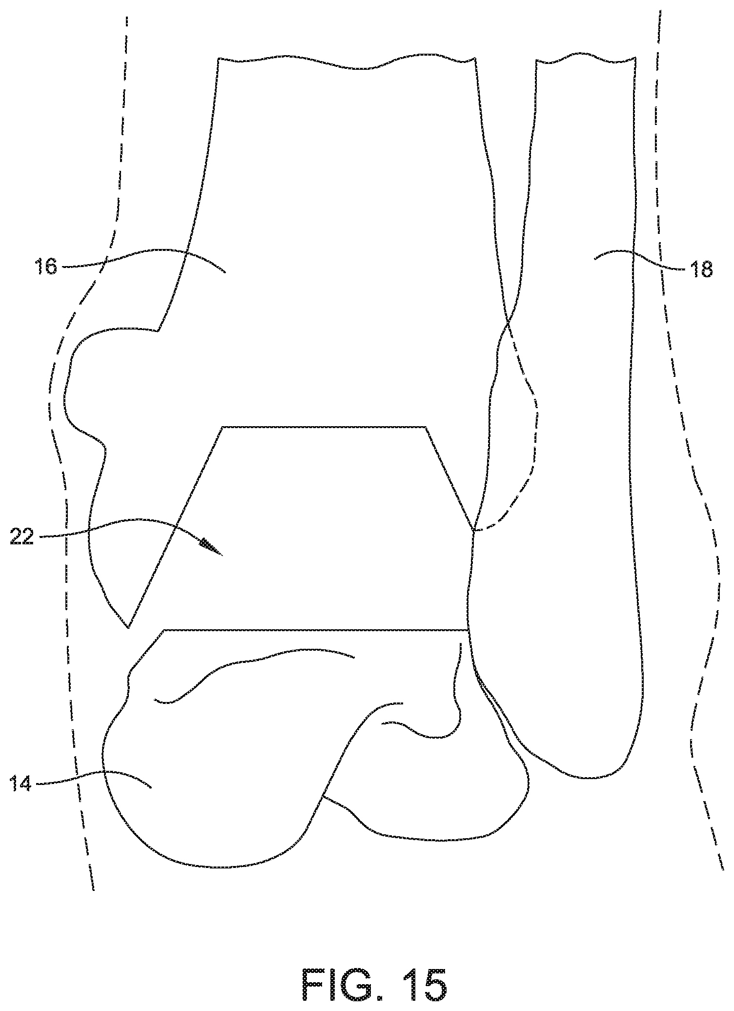 Patent US11779356 Figure 13 – Orthopedic surgical guide