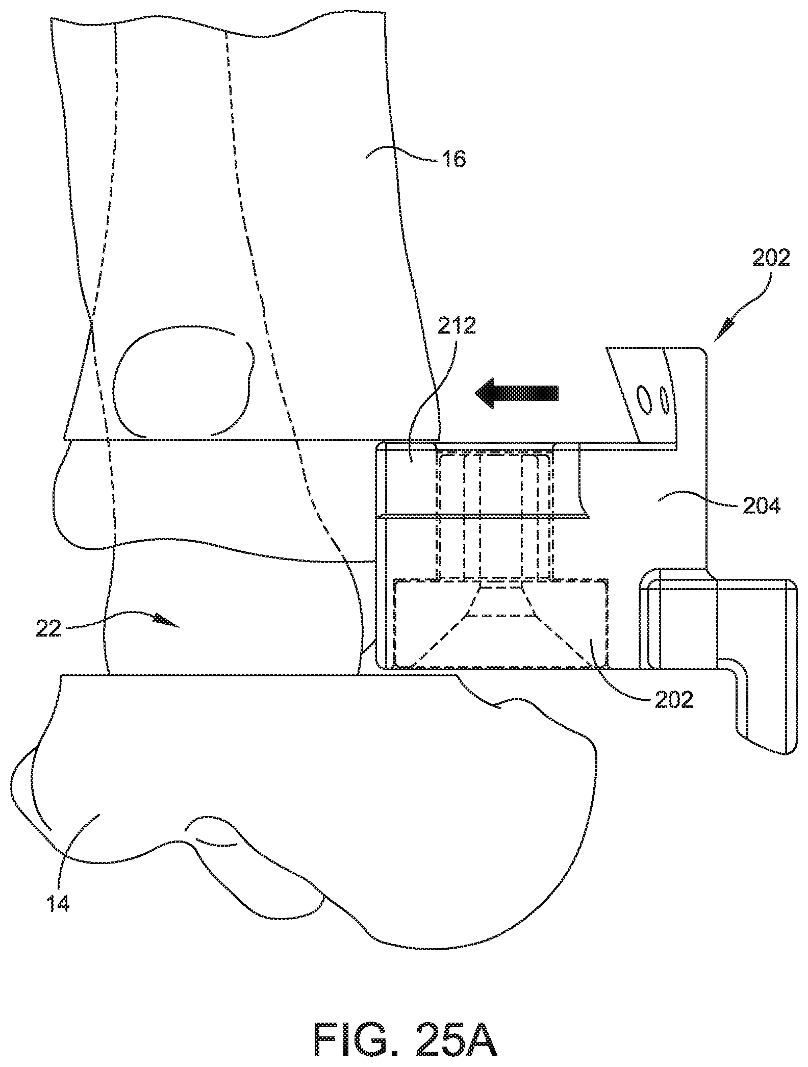 Patent US11779356 Figure 19 – Orthopedic surgical guide