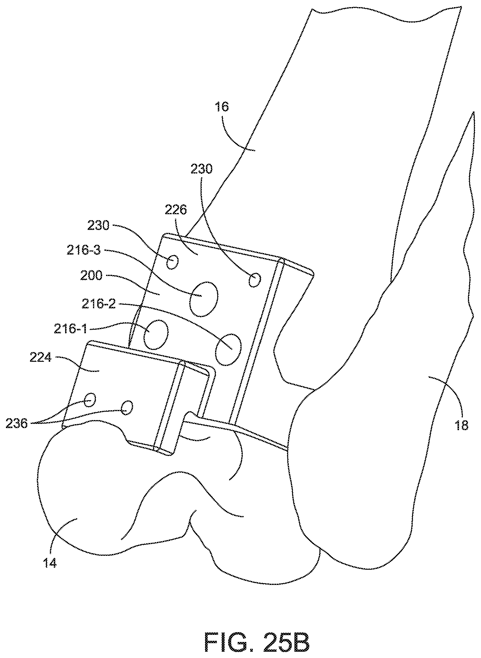 Patent US11779356 Figure 20 – Orthopedic surgical guide