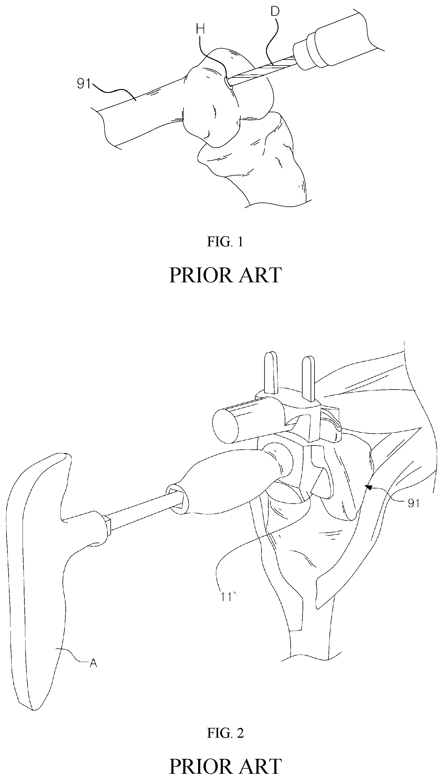 Patent US11779357 Figure 1 – Detector for artificial joint replacement