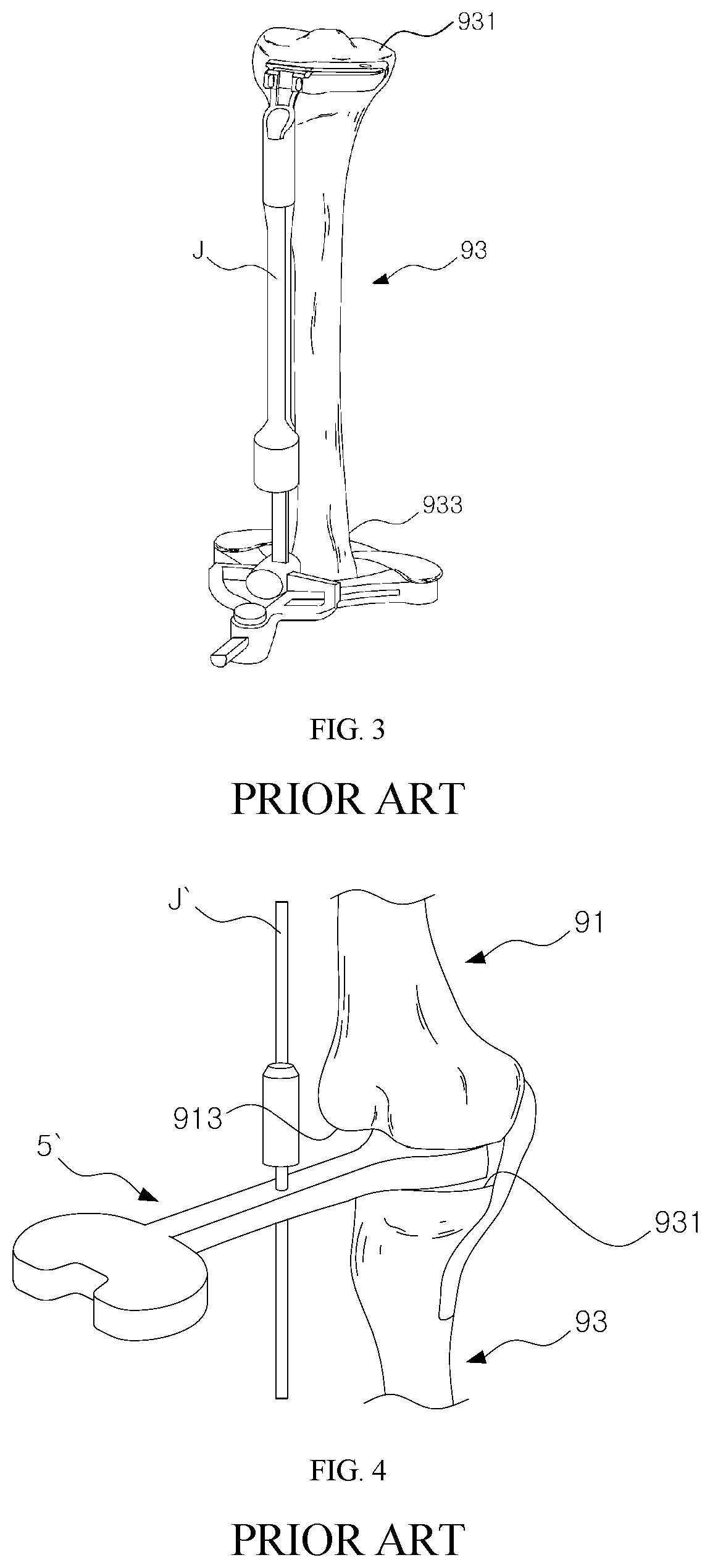 Patent US11779357 Figure 2 – Detector for artificial joint replacement