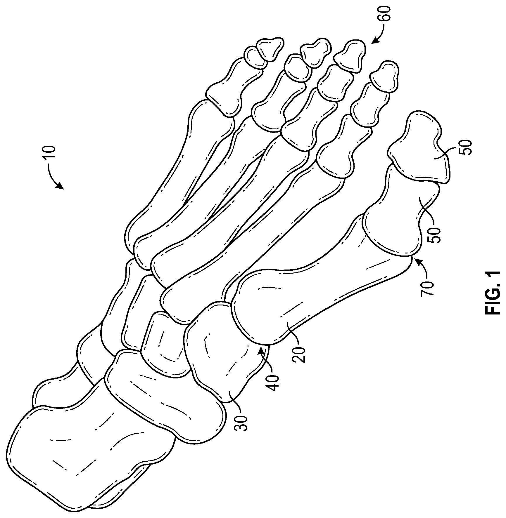 Patent US11779359 Figure 1 – Systems and methods for Lapidus repair of bunions