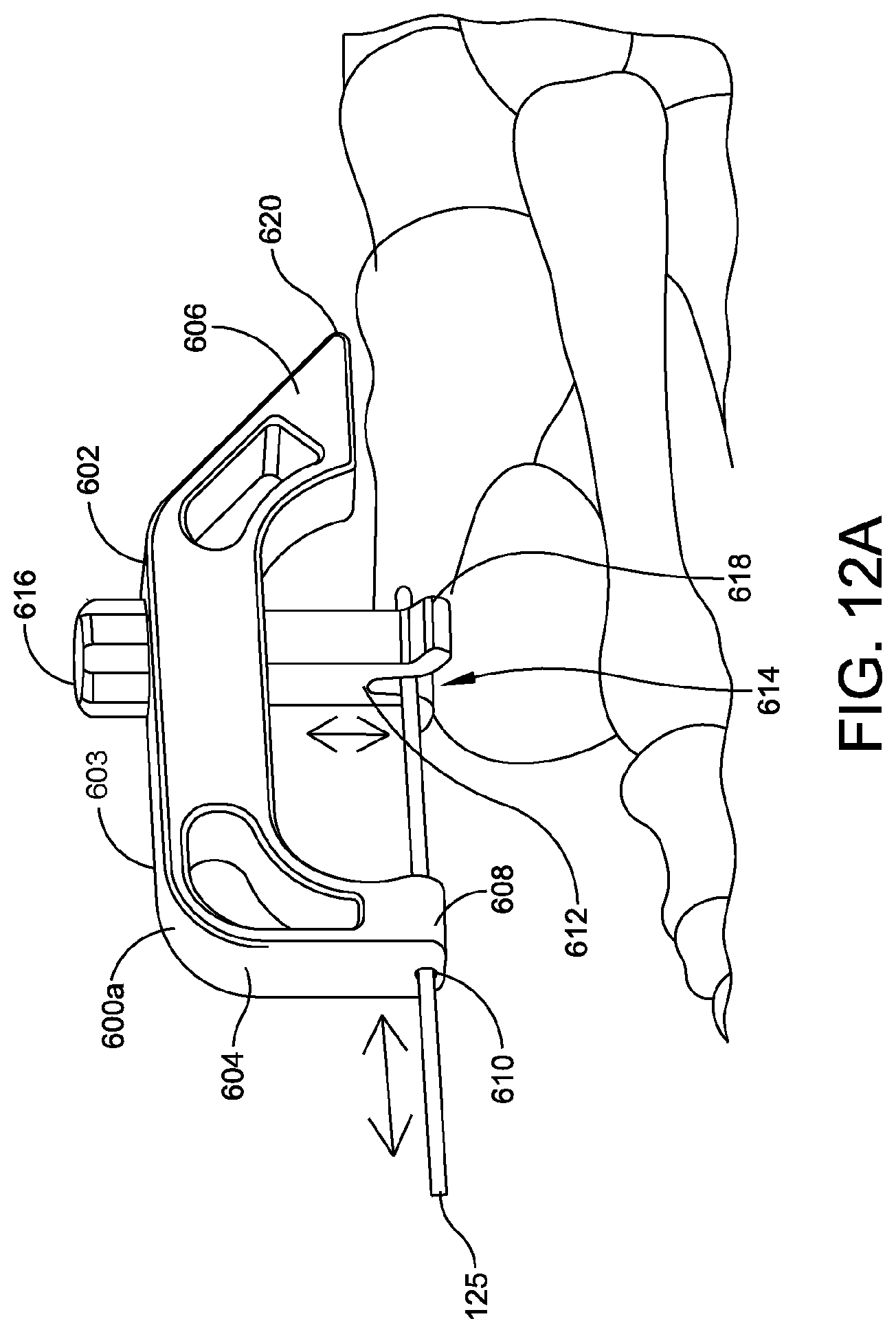 Patent US11779360 Figure 15 – Chevron osteotomy tools and methods